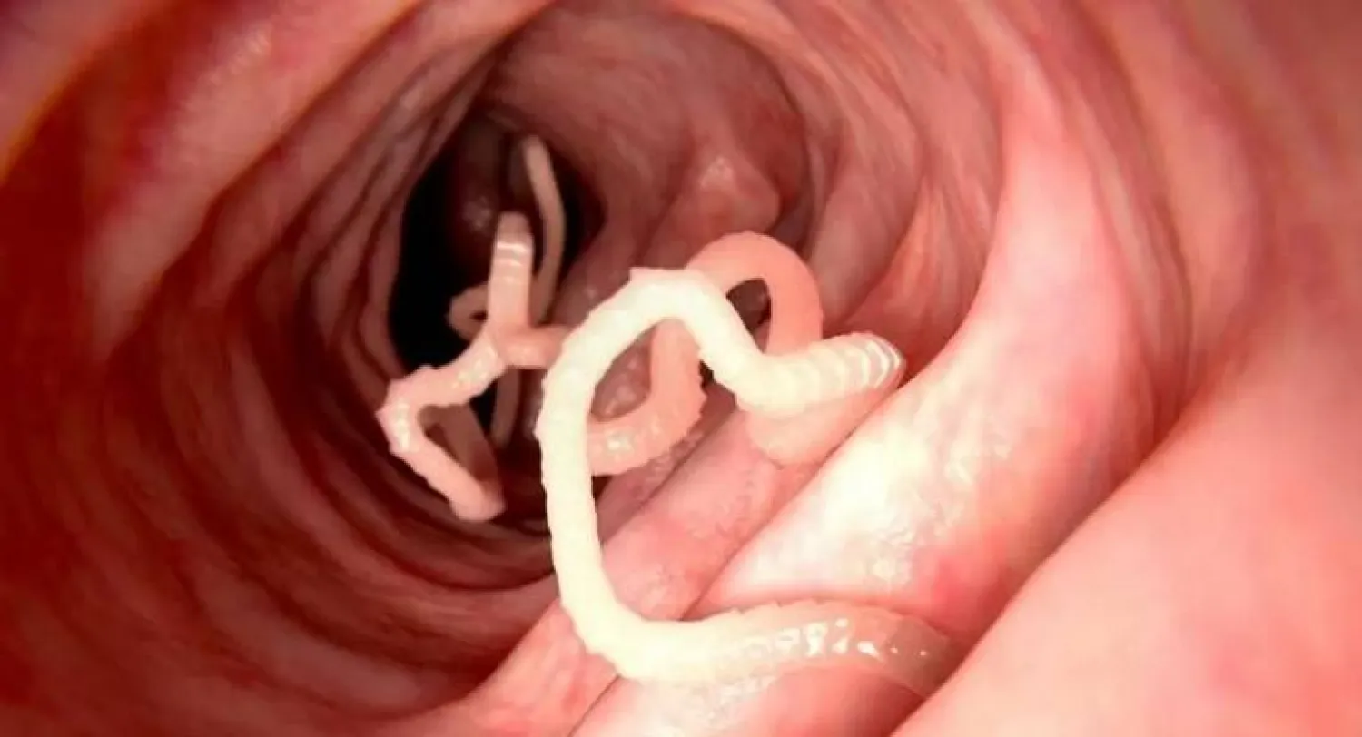 الديدان الطفيلية قد تنتقل إلى العين أيضا !