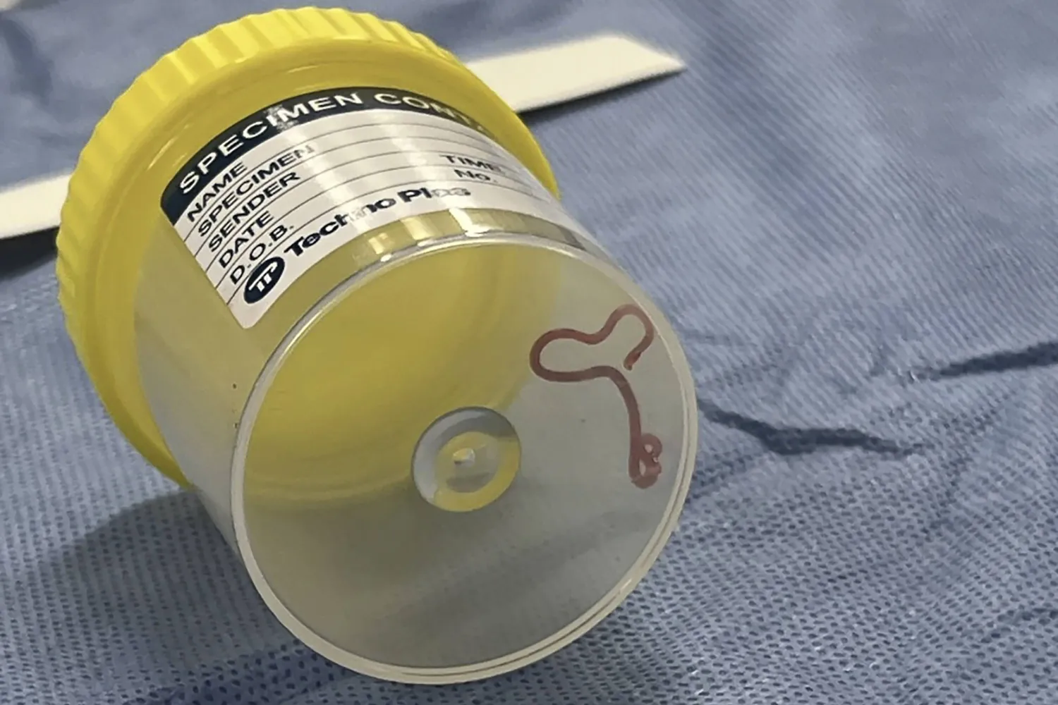 This undated photo supplied by Canberra Health Services, shows a parasite in a specimen jar at a Canberra hospital in Australia. (Canberra Health Services via AP)