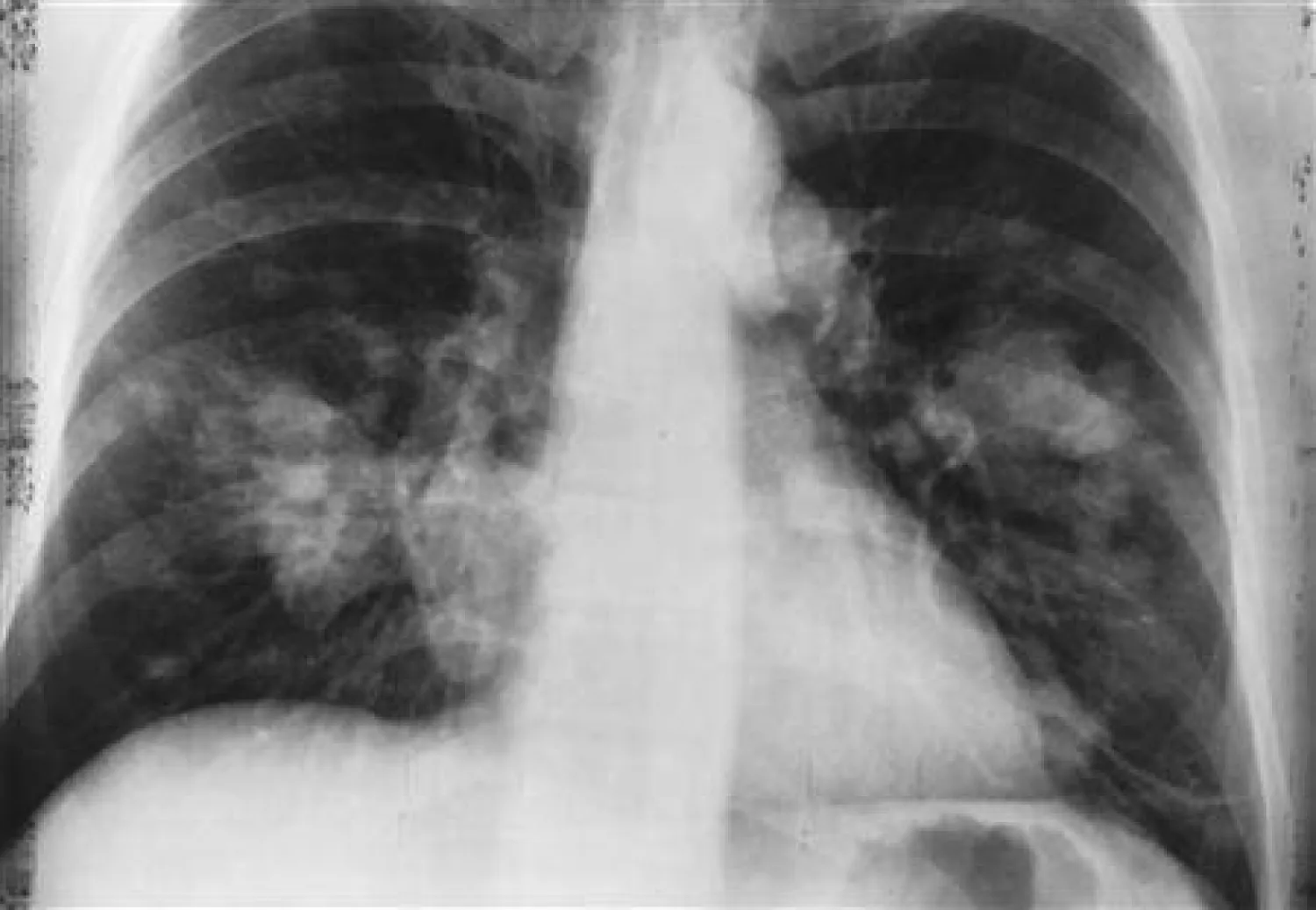 اكتشافات جديدة لخلايا مناعية تعزز علاج سرطان الرئة