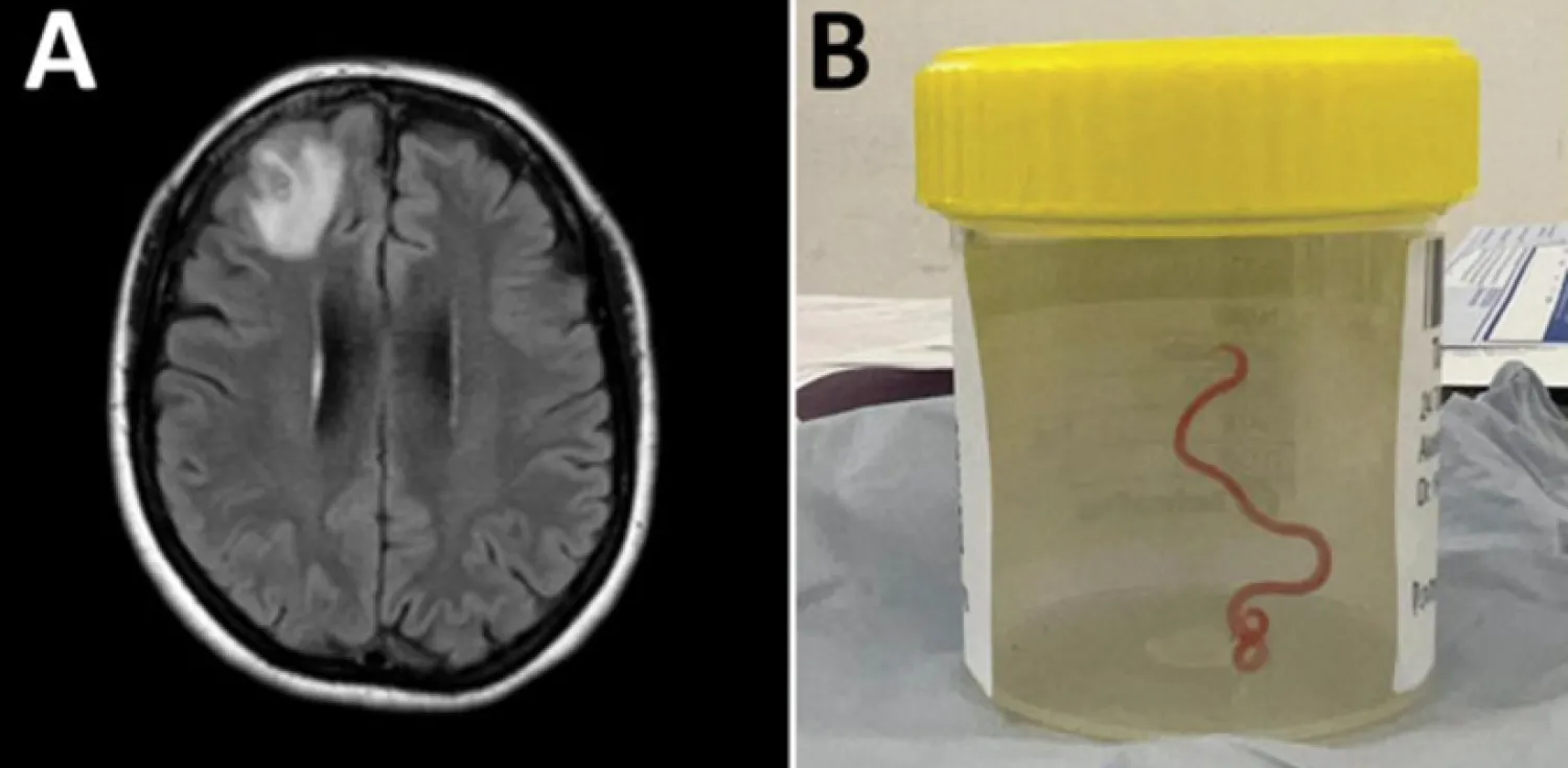 Hastanın ve solucanın çıkarıldıktan sonraki manyetik rezonans görüntüsü (ABD Hastalık Kontrol ve Önleme Merkezi)