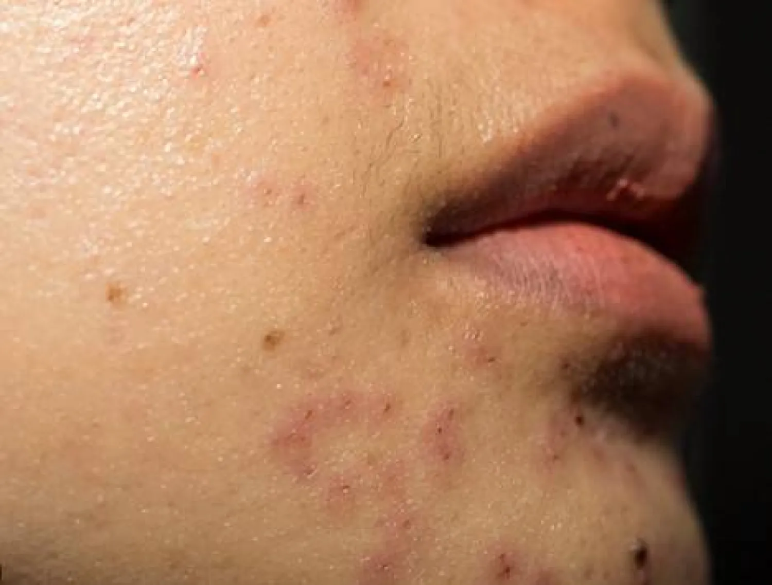 مركب مضاد للبكتيريا... علاج جديد لحبّ الشباب