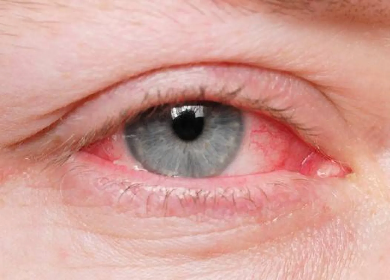 «وباء العين الوردية» يجتاح أجزاء من آسيا ويصيب الآلاف