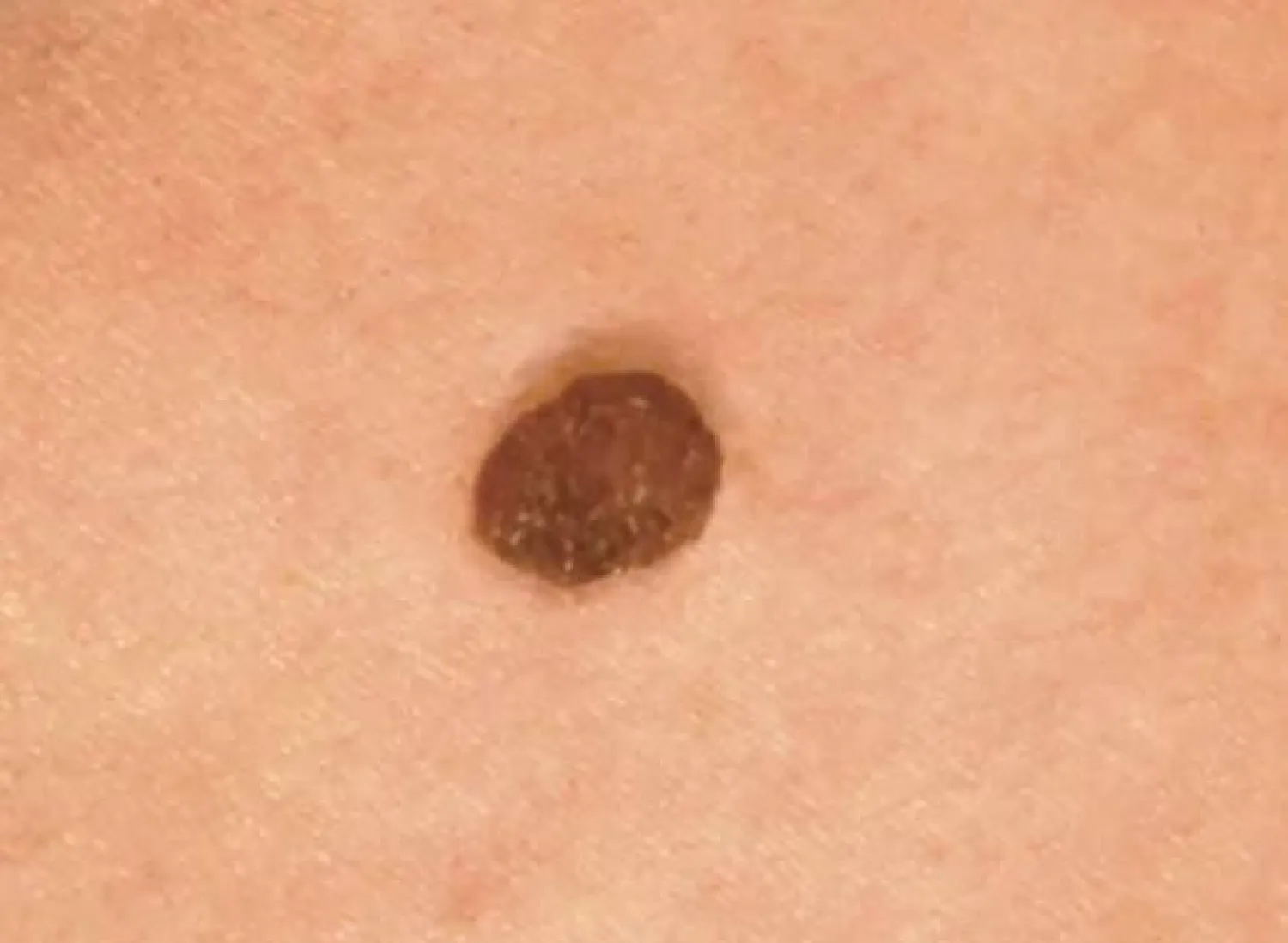 الوفيات بسرطان الجلد غير الميلانيني أكبر منها بسرطان الجلد