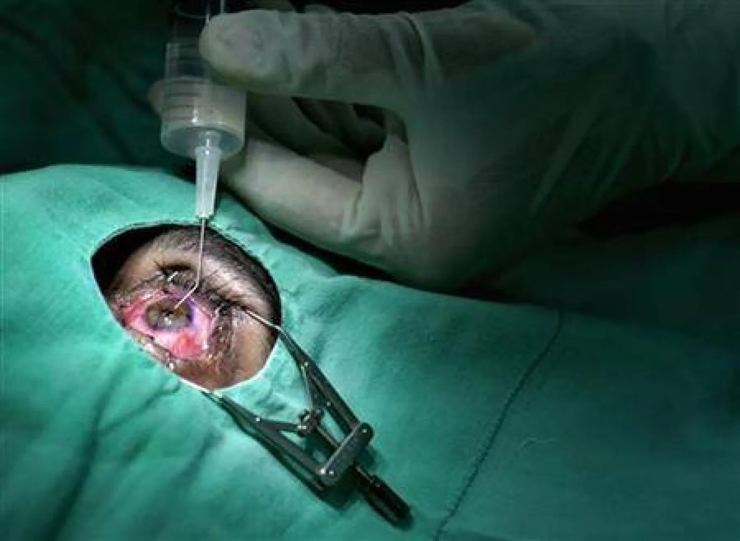 A doctor performs free eye surgery in this file photo dated September 12, 2006. REUTERS/Enrique De La Osa