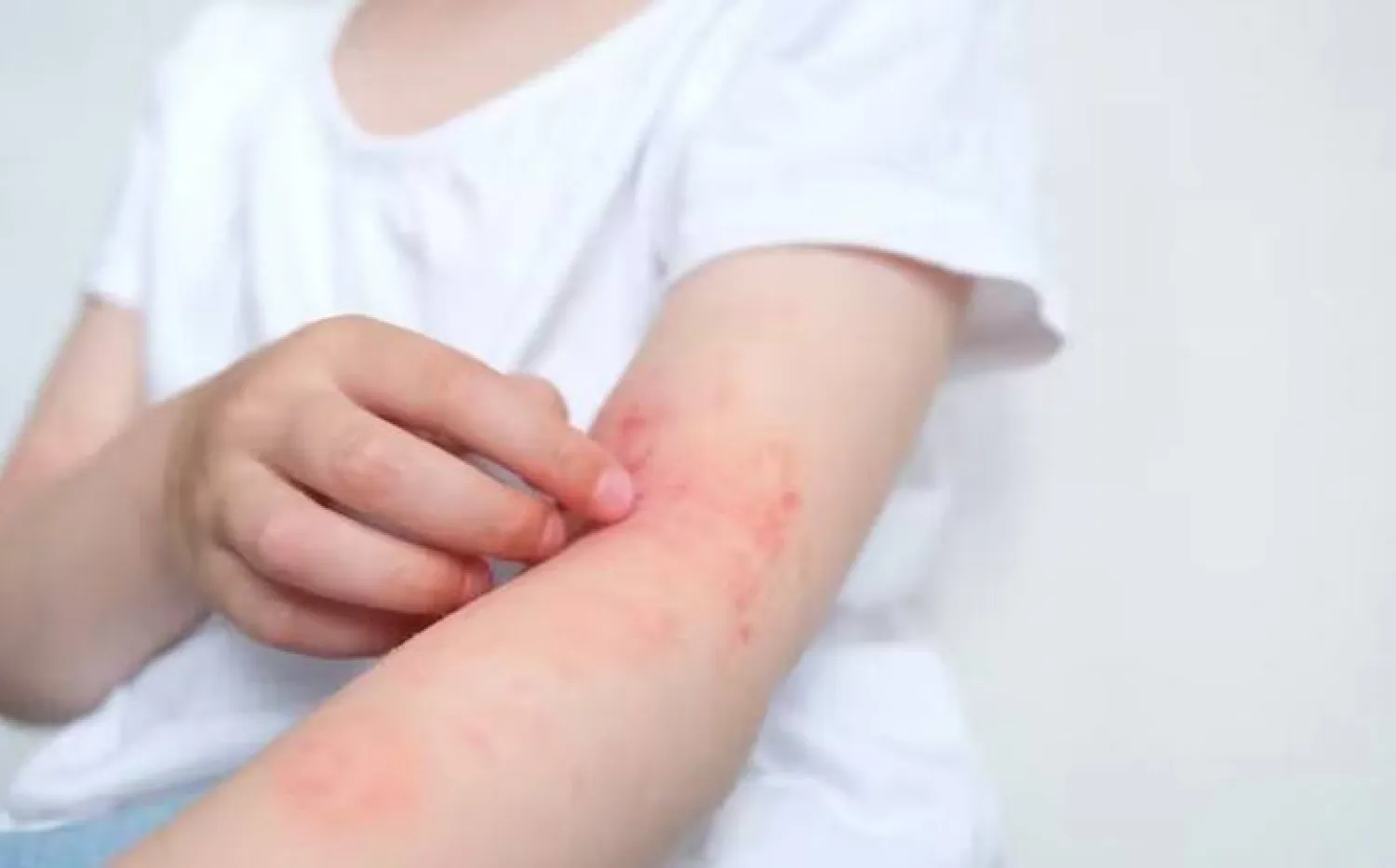 اكتشاف مسبب غير متوقع للأكزيما... وأدلة حول كيفية إيقافه