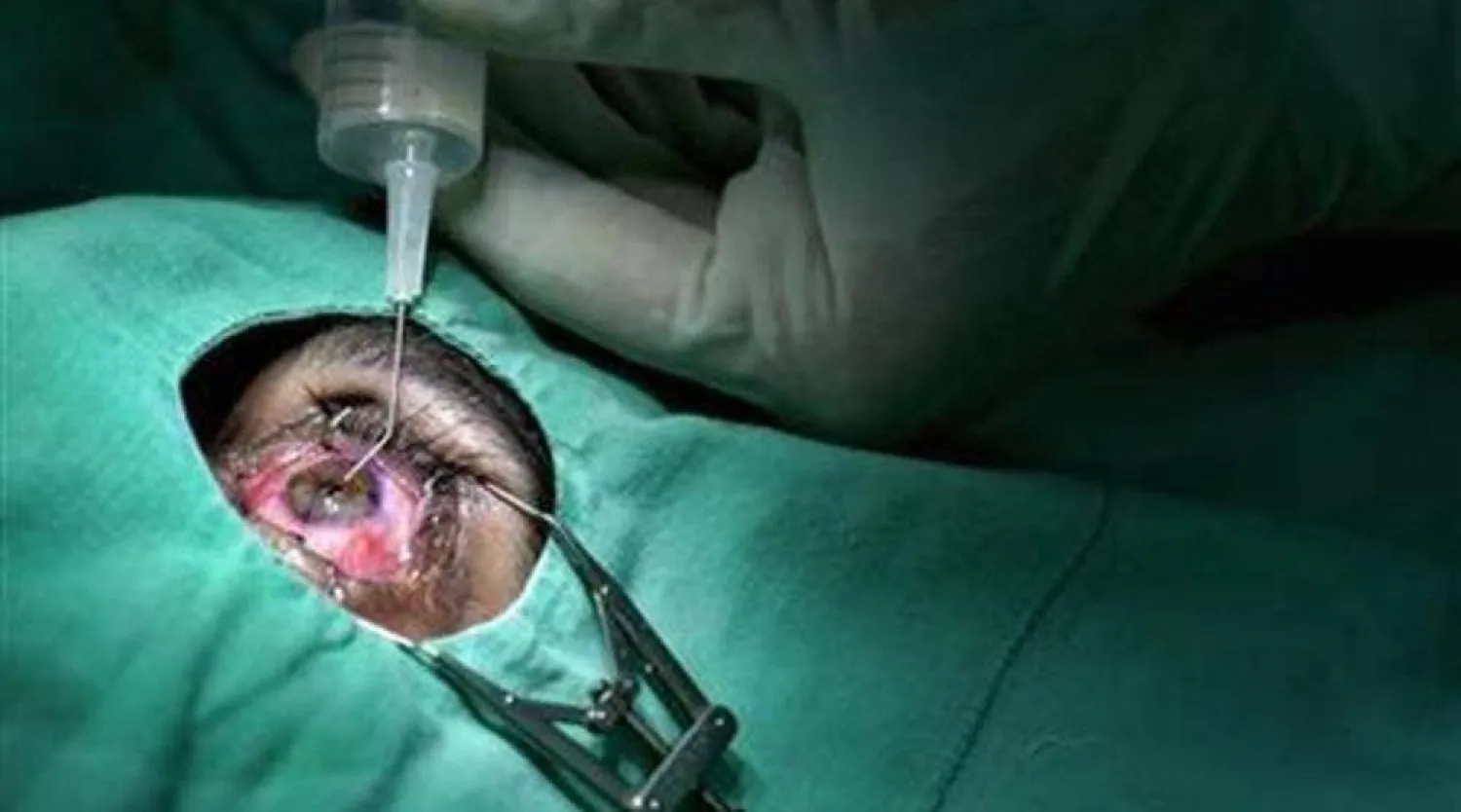 طريقة جراحية جديدة لعلاج الحالات المعقدة لجحوظ العينين