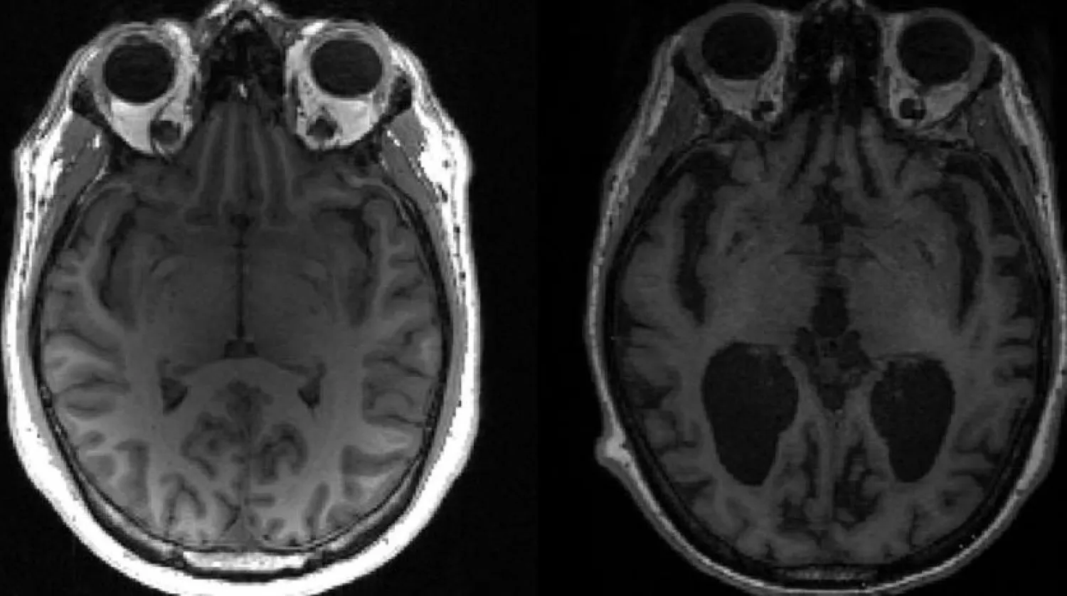 This undated image courtesy of, Dr. Timothy Rittman, University of Cambridge, shows an MRI image of a healthy brain (L) and an Alzheimer's brain (R) with large black gaps where brain has shrunk. (AFP)

