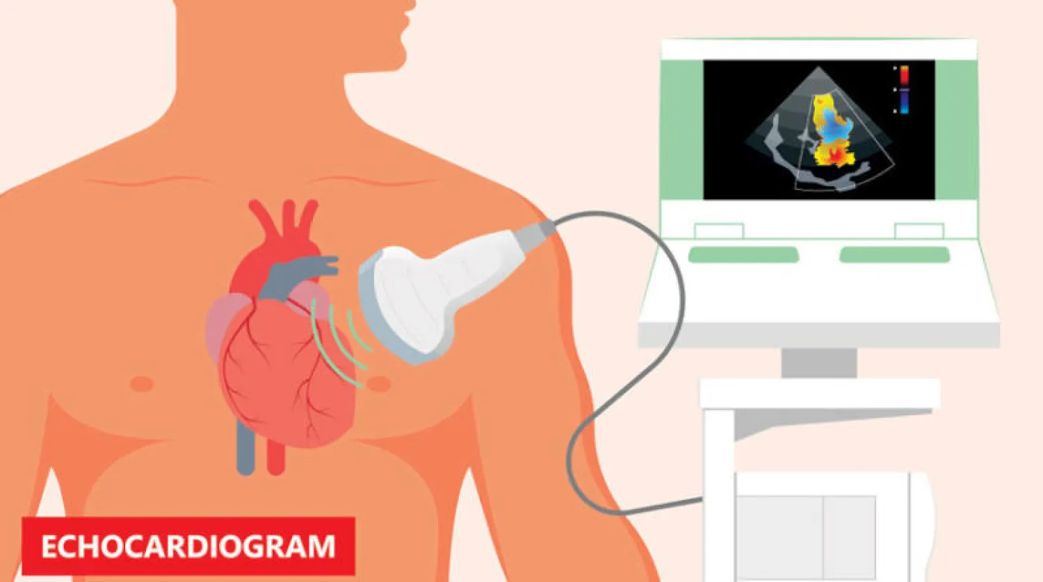 «دراسة الفقاعة» ترصد سبب السكتة الدماغية المفاجئة