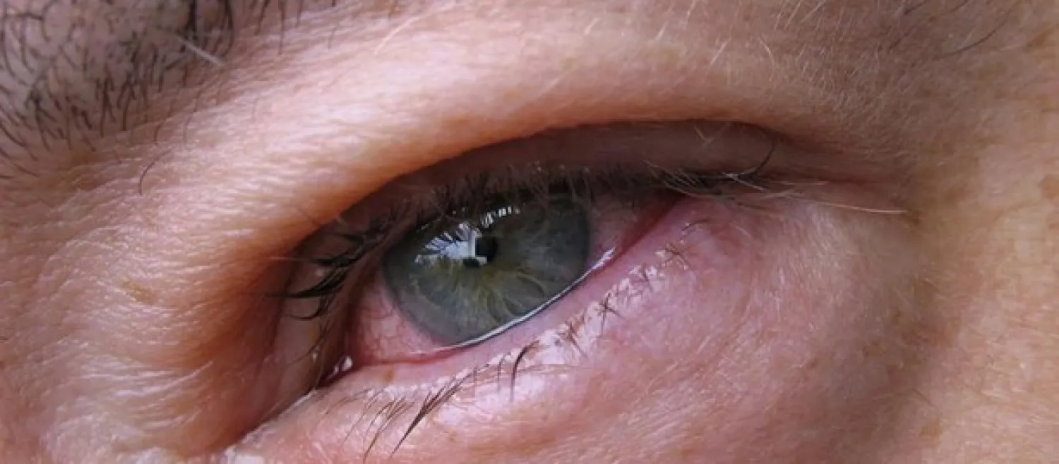 تقرير: منتج قطرات للعين قد يرتبط بالتهابات بكتيرية مقاومة للأدوية