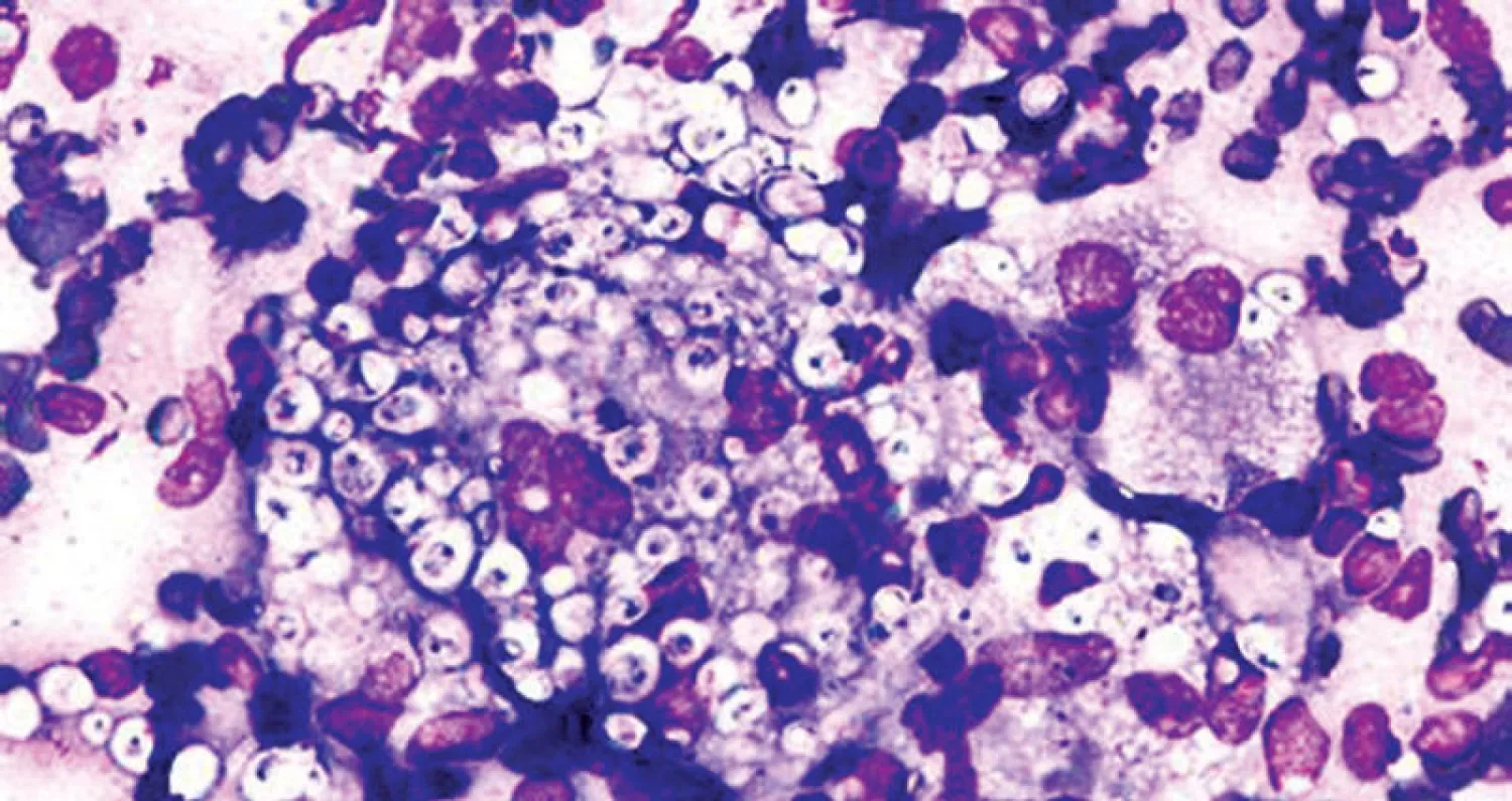 المبيضات لفيطر أوريس (مراكز السيطرة على الأمراض) غيتي
