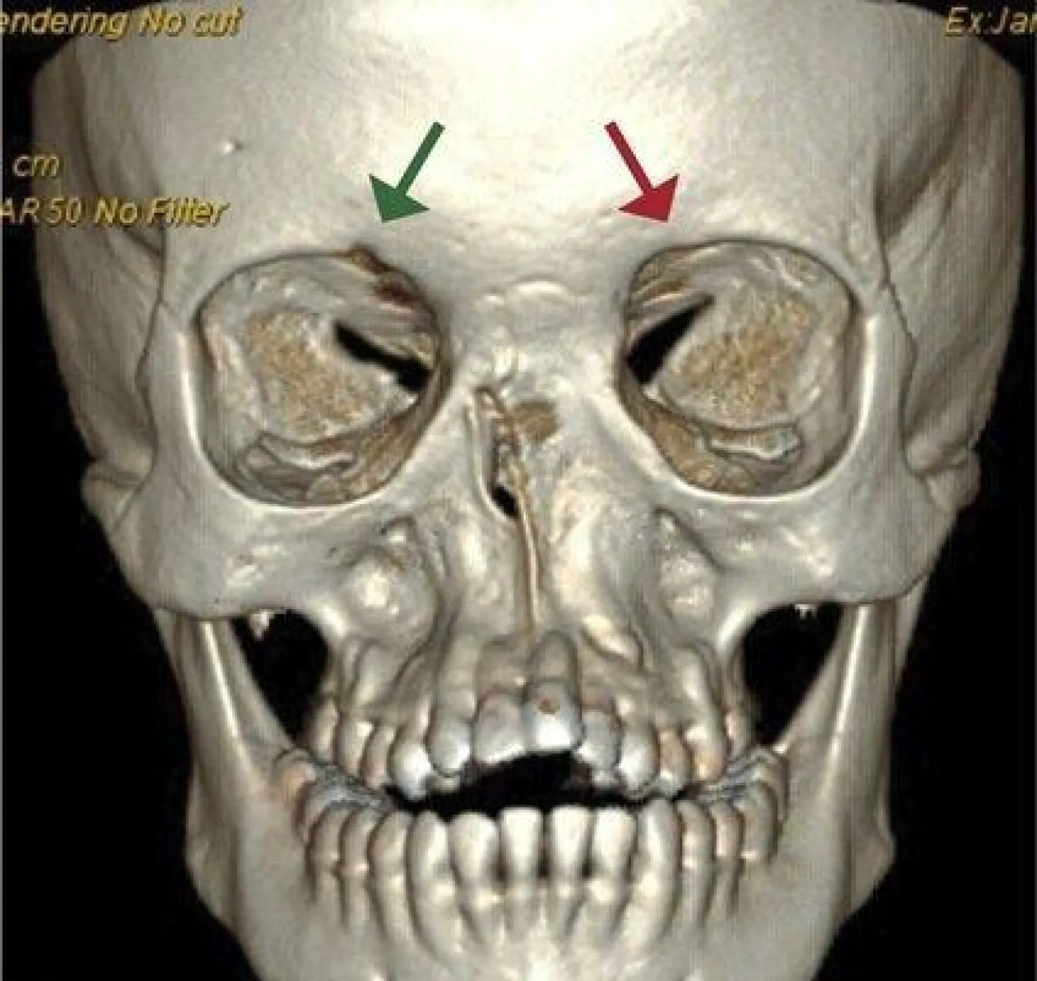 التصوير المقطعي المحوسب قبل الجراحة (دورية جراحة الوجه القحفي)