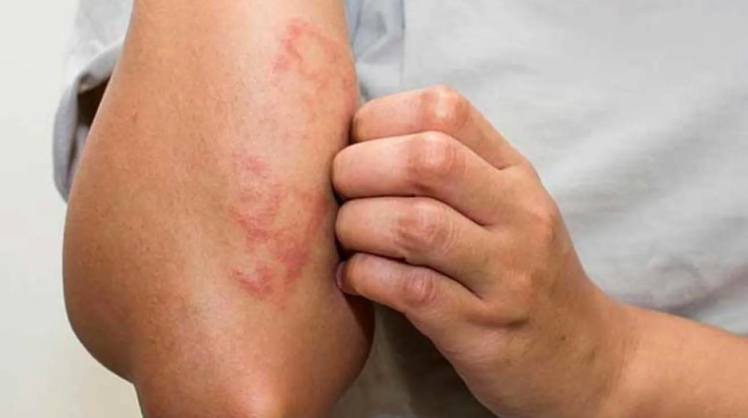 ارتفعت معدلات الإصابة بالإكزيما بمقدار مرتين إلى ثلاث مرات في البلدان الصناعية منذ السبعينات (رويترز)
