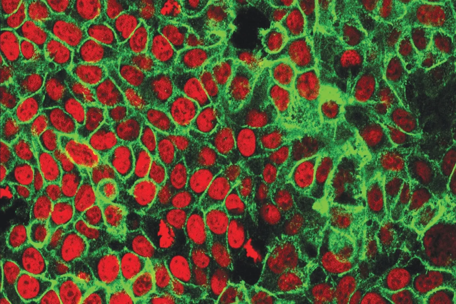 This microscope image made available by the US National Cancer Institute Center for Cancer Research in 2015 shows human colon cancer cells with the nuclei stained red. AP file photo