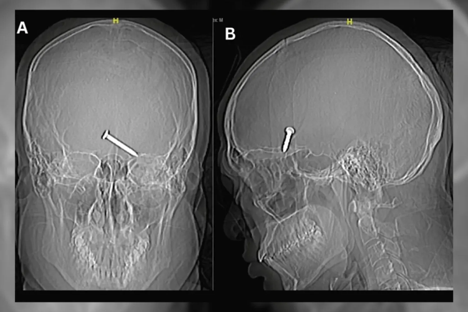 Tomografide çivinin, beynin bilinçli düşünmeden sorumlu bölgesi olan frontal loba girdiği belirlendi (Cureus)