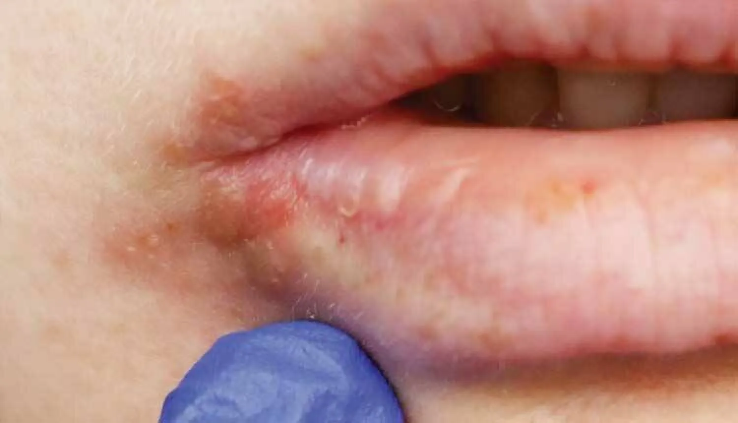 دراسة: فيروس الهربس يضاعف خطر الإصابة بالخرف !