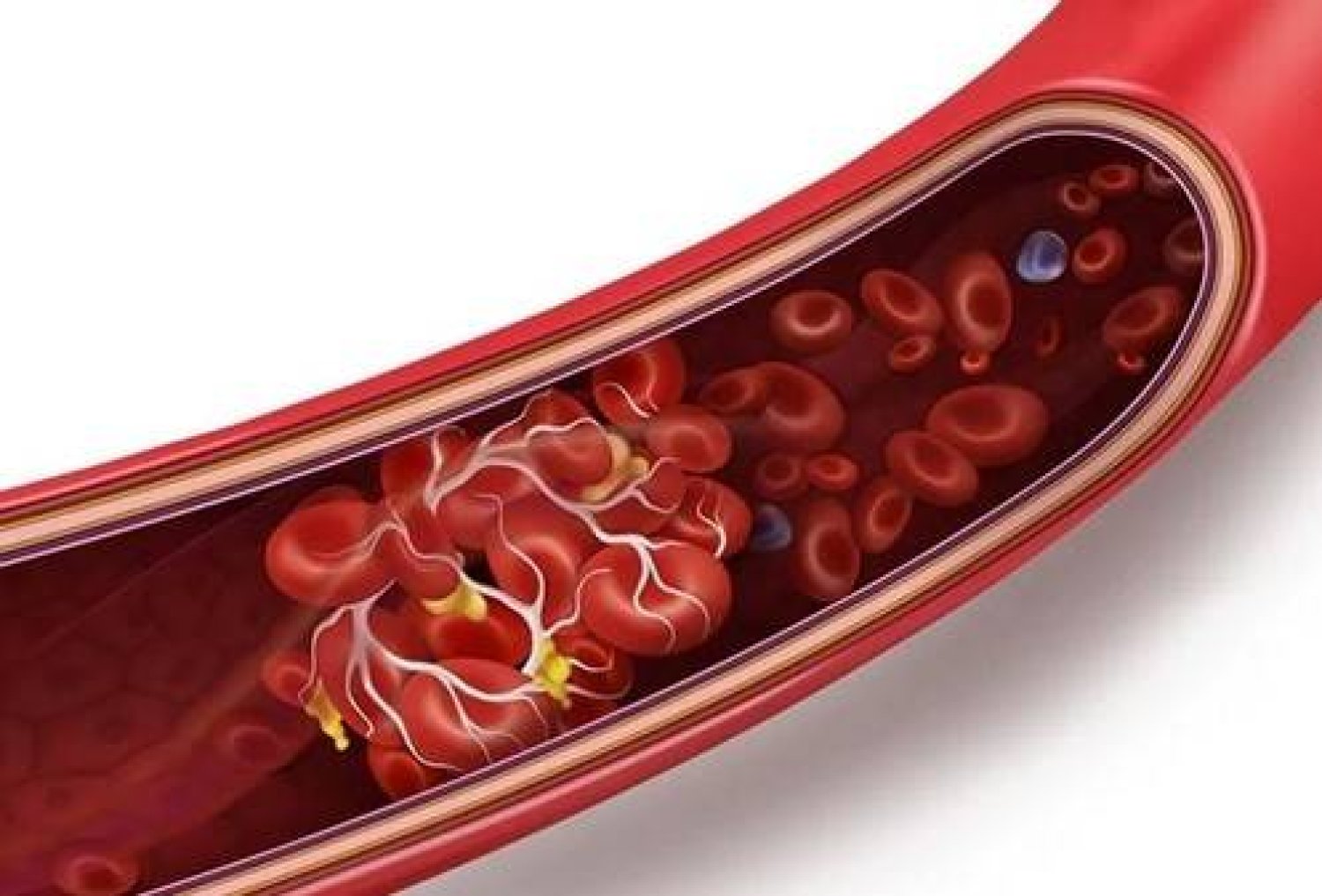 تطوير جهاز نانوي ذكي يعالج التخثّر