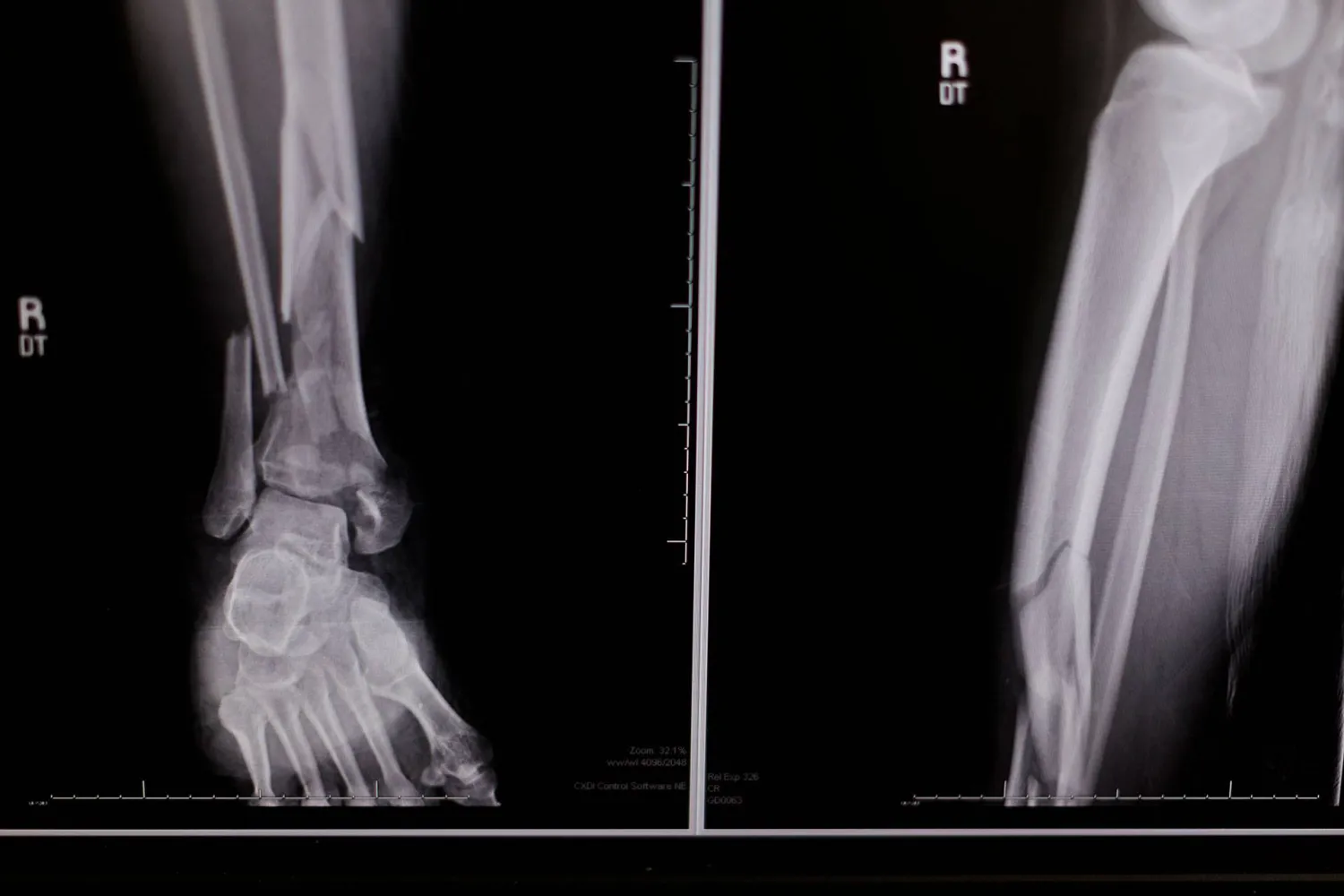 التعرض للسقوط يزيد من خطر الإصابة بالكسور (رويترز)