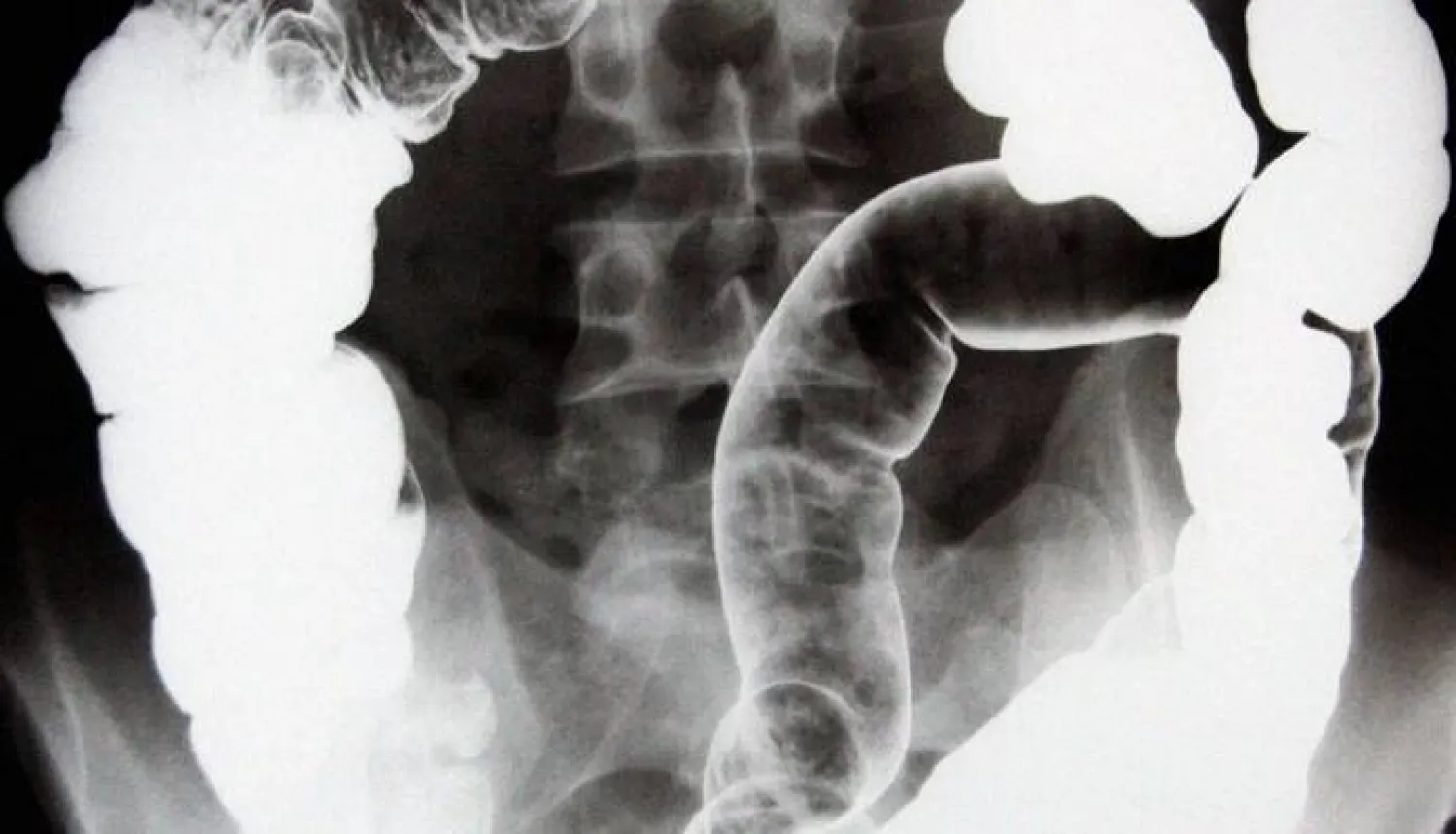 دراسة تكشف العلامات المبكرة لالتهاب الأمعاء