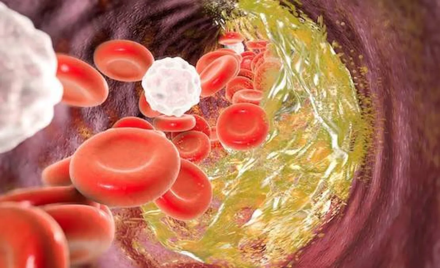 ما هو ارتفاع كوليسترول الدم الوراثي ؟