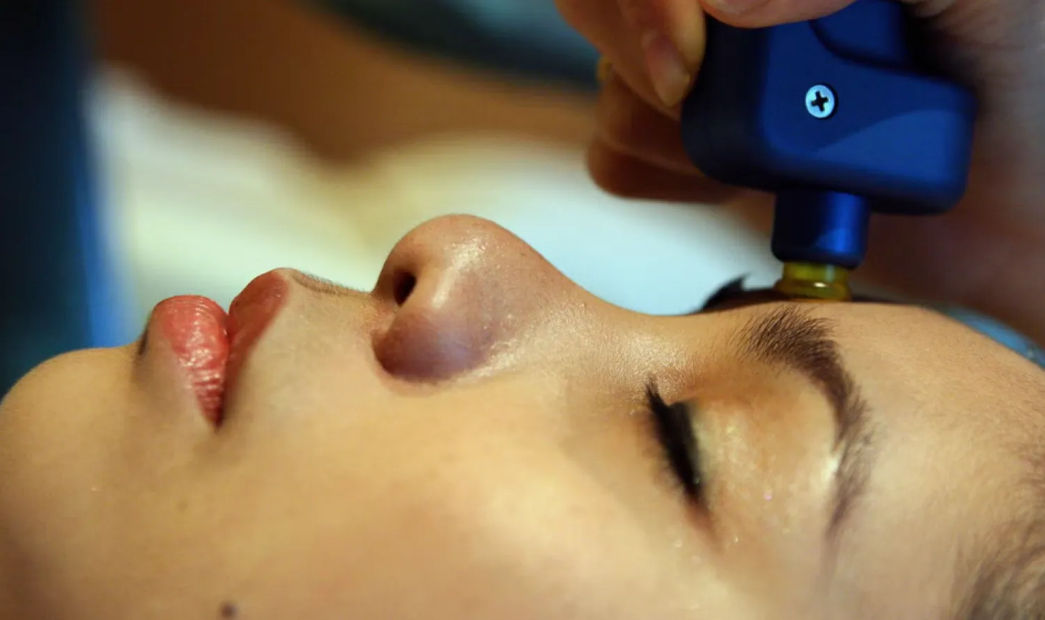 النساء خضعن لإجراء تجميلي تستخدم فيه الإبر يدعى «تقنية الفامبير لشد الوجه» (أ.ف.ب)