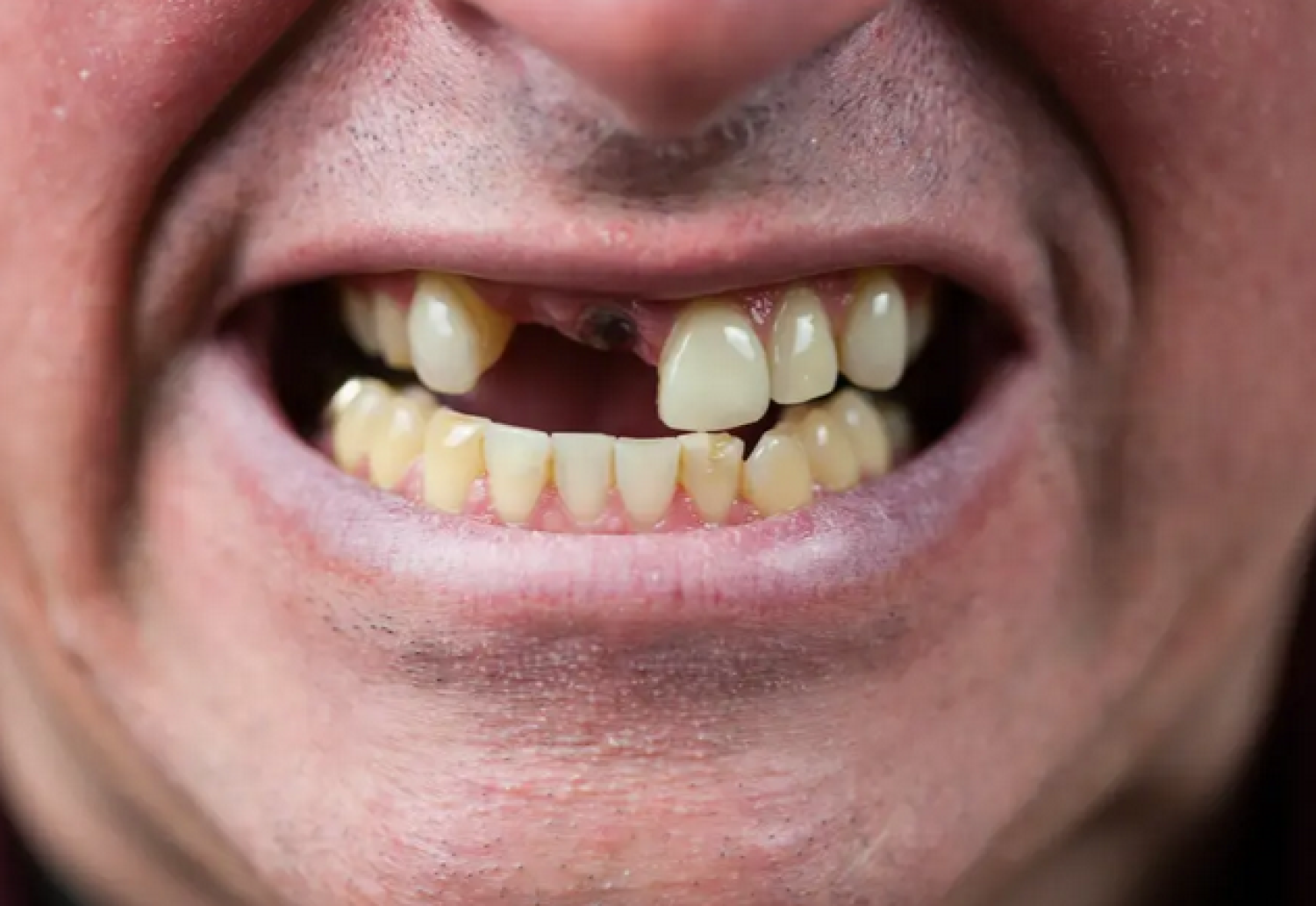 سبتمبر المقبل موعدا لبدء اختبار دواء يعيد الأسنان المفقودة