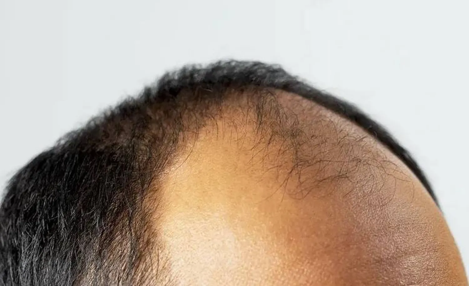 معادن مهمة لعلاج الثعلبة البقعية المسببة لتساقط الشعر