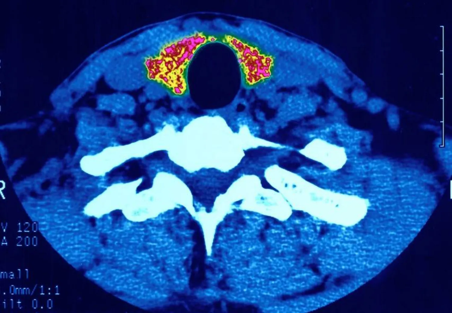 أعراض تشير لأمراض الغدة الدرقية... تعرّف عليها