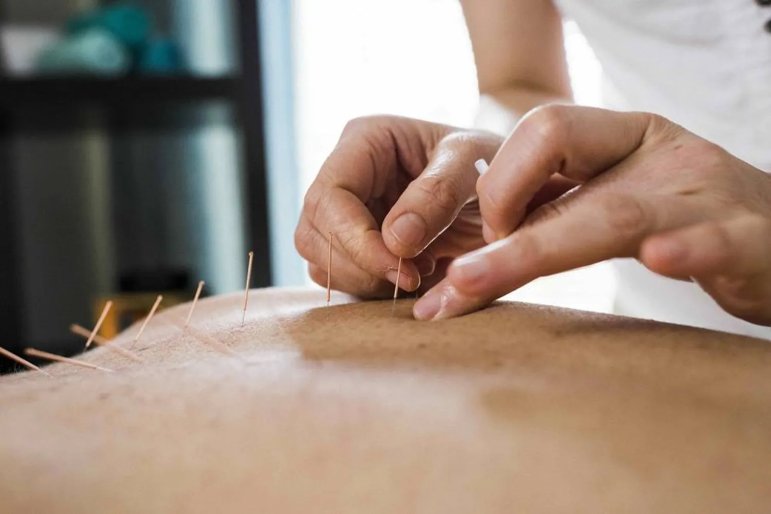 الوخز بالإبر هو تقنية علاجية من الطب التقليدي الصيني (جامعة ملبورن)