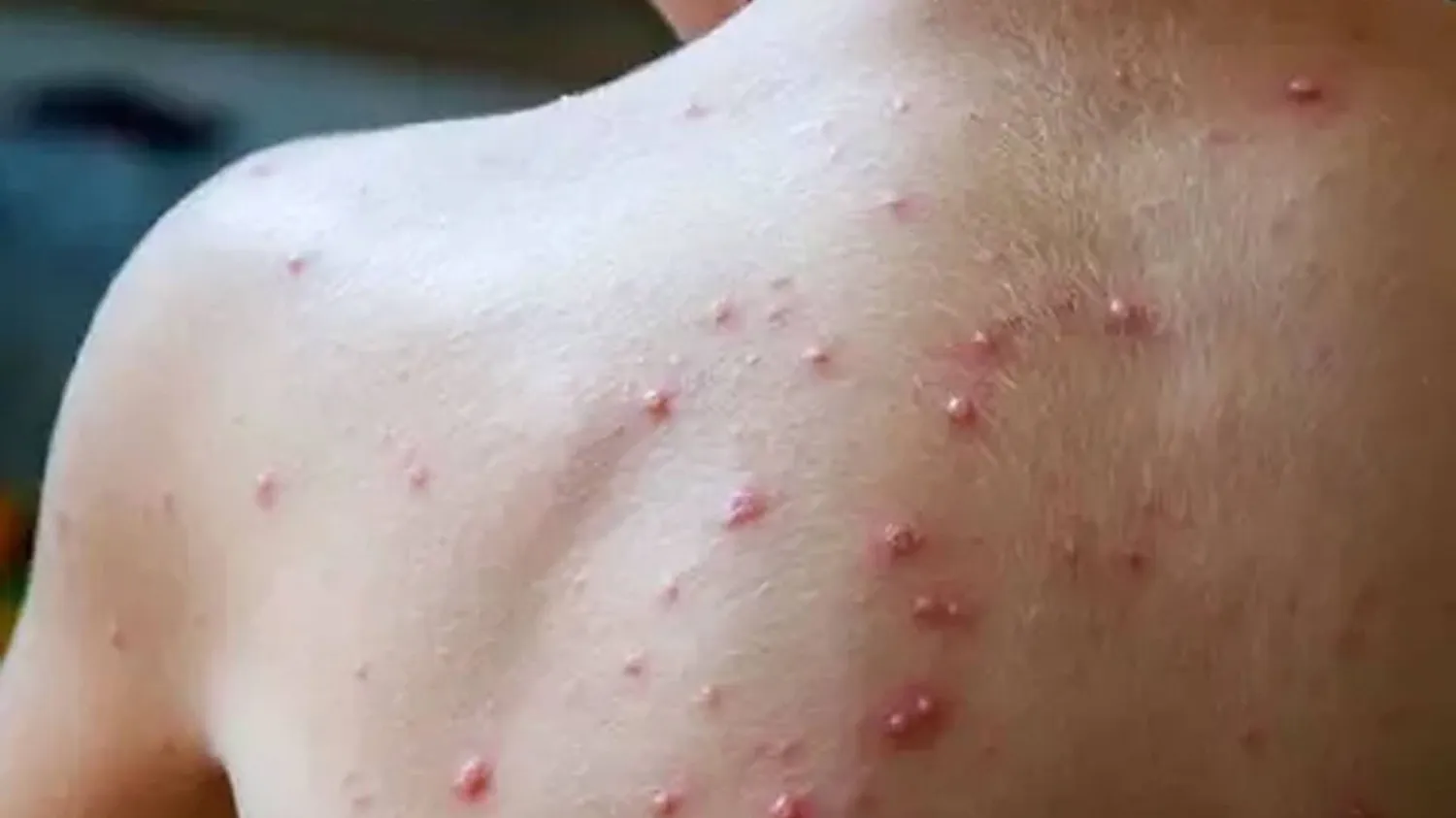 جدري القردة ليس «كوفيد الجديد»