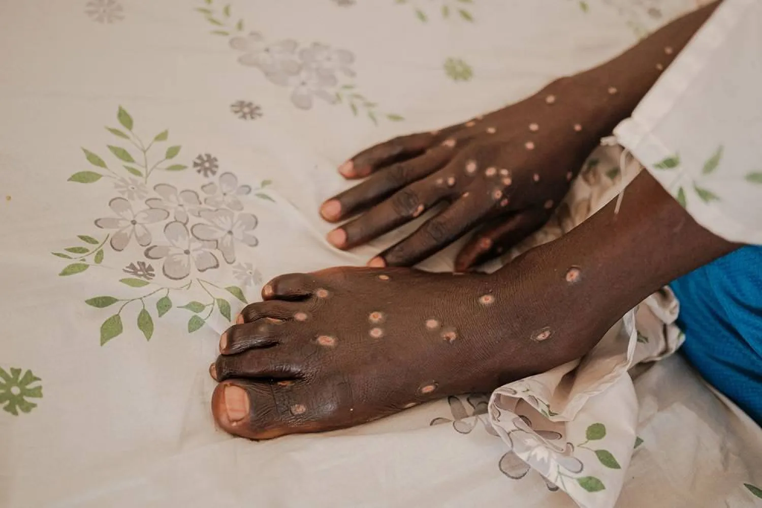A man infected with mpox lies on a bed inside a ward at the Kamenge University Hospital's mpox treatment center in Bujumbura on August 22, 2024. (AFP)