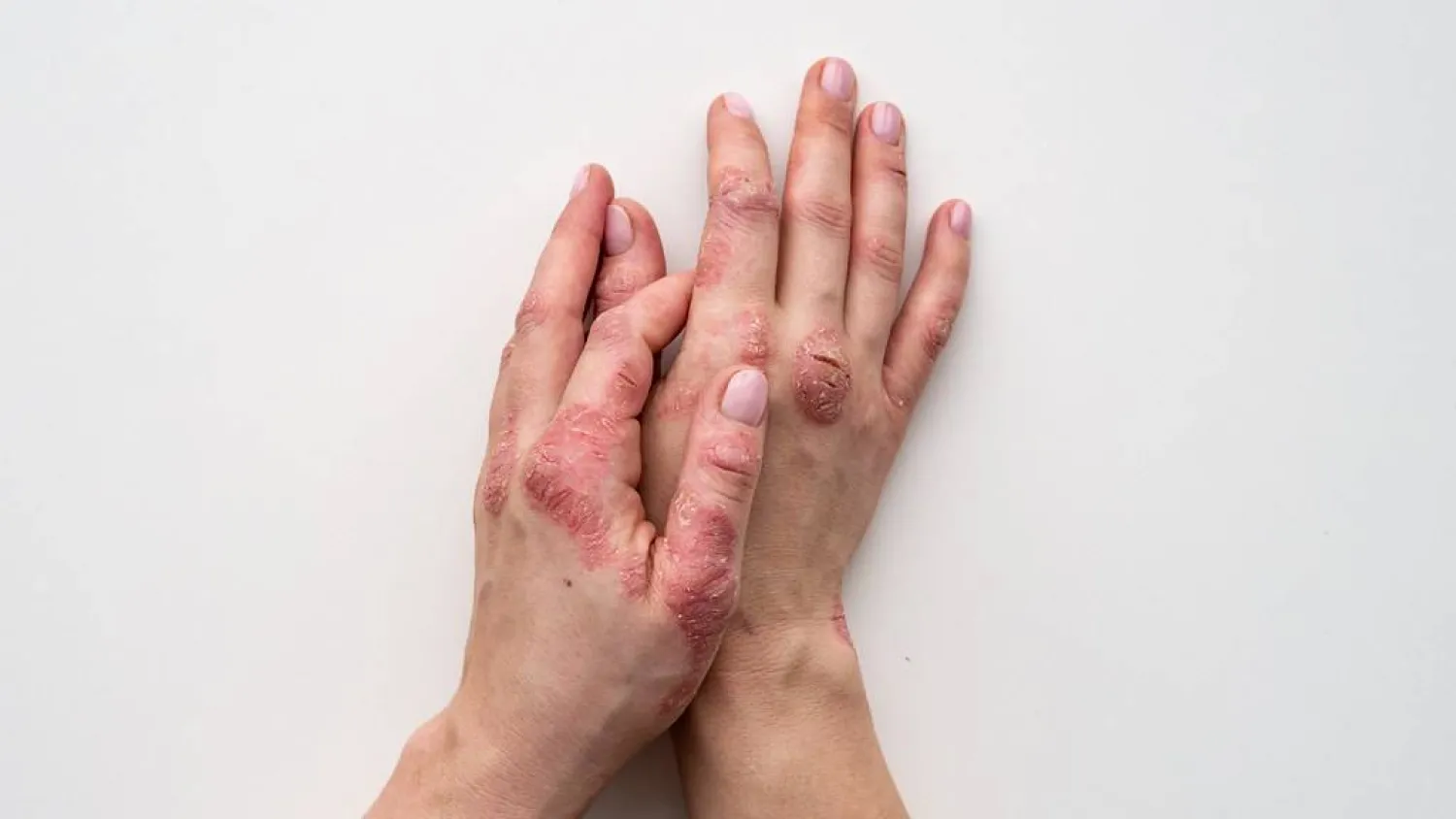 مرض الصدفية يتميز بظهور بقع حمراء متقشرة على الجلد (جامعة باث)