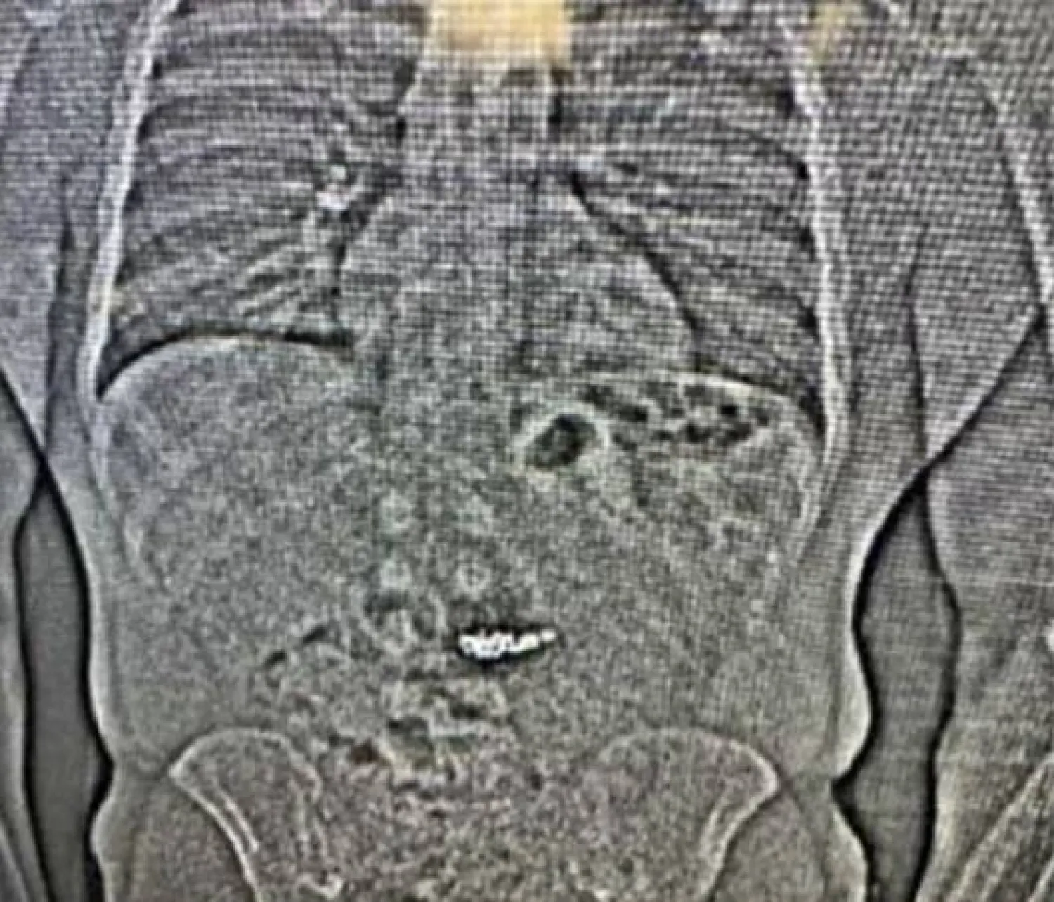 صورة أشعة تُظهر أقراطاً تمت سرقتها من متجر مجوهرات وسط فلوريدا (أ.ب)