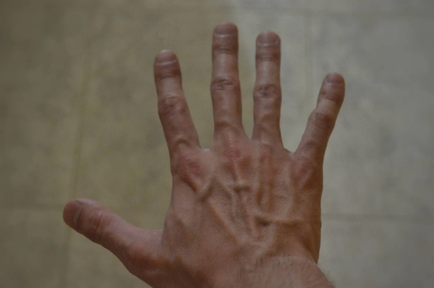 استشارات: انتفاخ أوردة ظاهر اليد