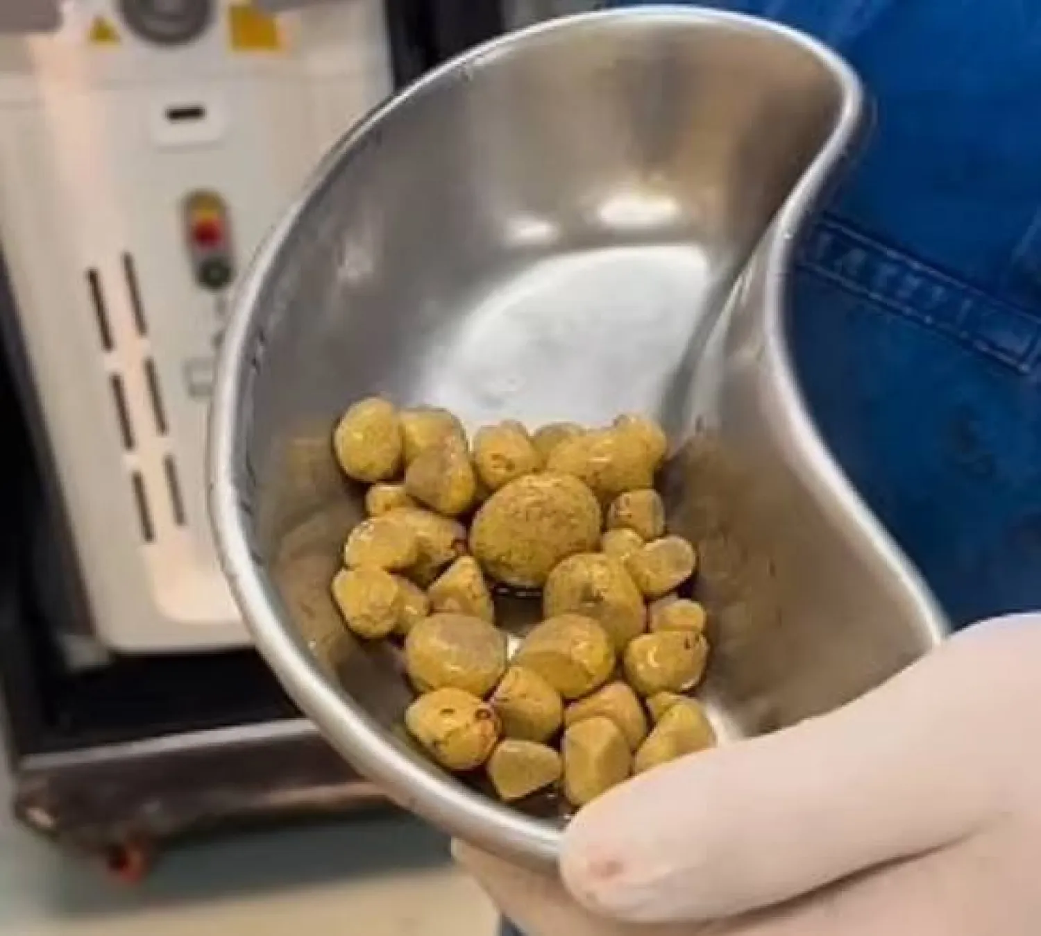 لقطة من الفيديو الذي نشره الدكتور ثاليس أندرادي على «إنستغرام» ويُظهر حصوات الكلى التي جرت إزالتها من مثانة المريض