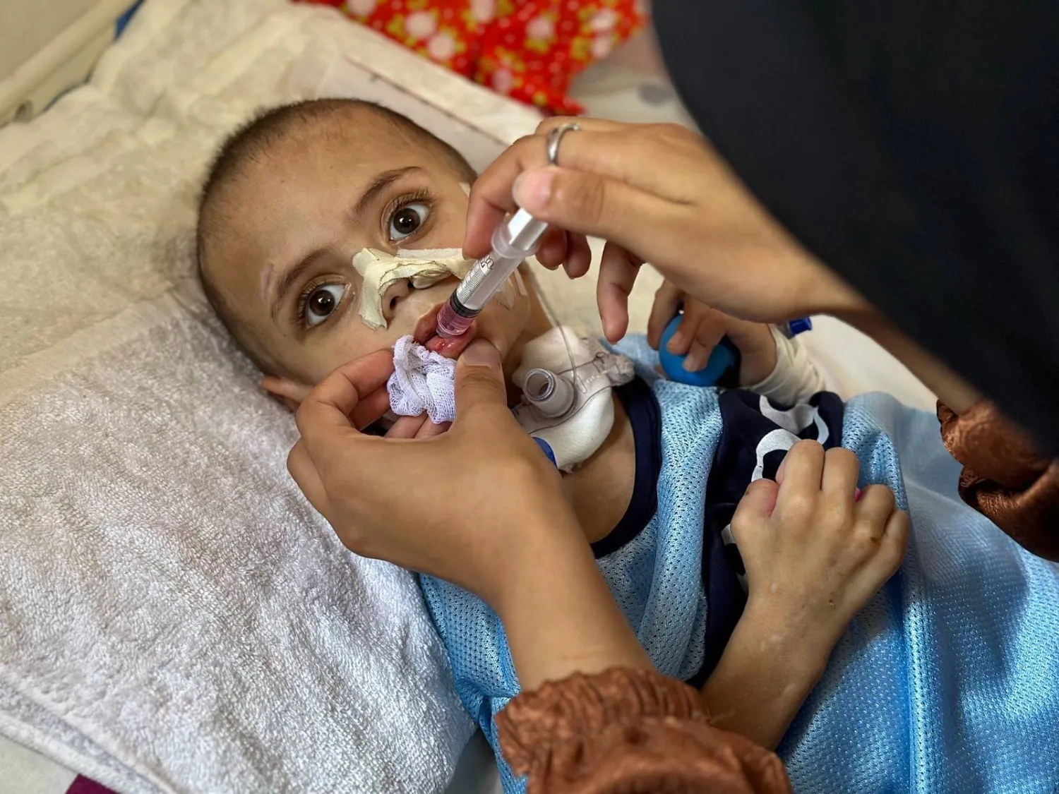 الطفل عمر الهمص يخضع للعلاج في مجمع ناصر الطبي بخان يونس جنوب قطاع غزة (الشرق الأوسط) 