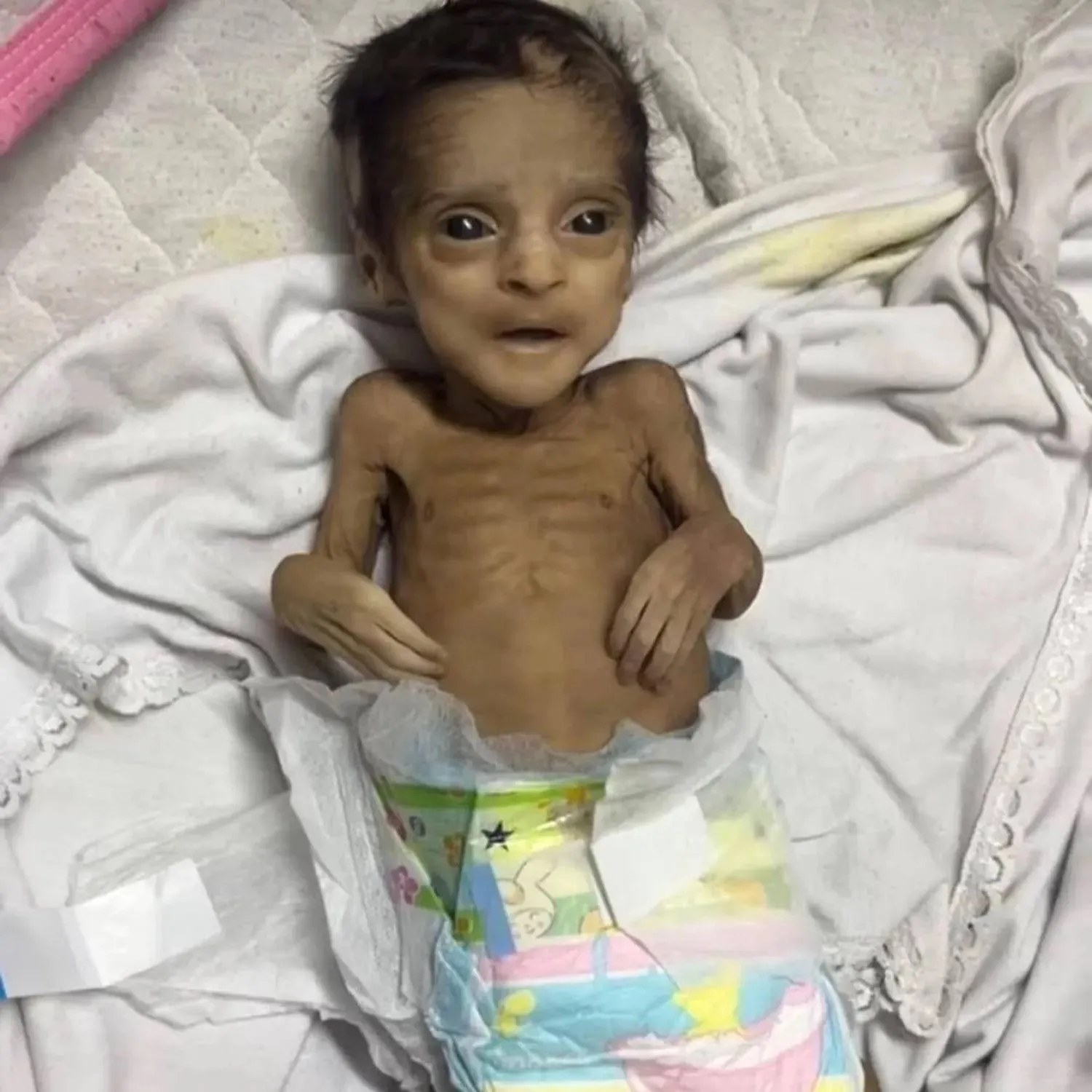 الطفل أحمد طليب الذي تُوفي نتيجة سوء التغذية والحصار الإسرائيلي على غزة (المركز الفلسطيني للإعلام)