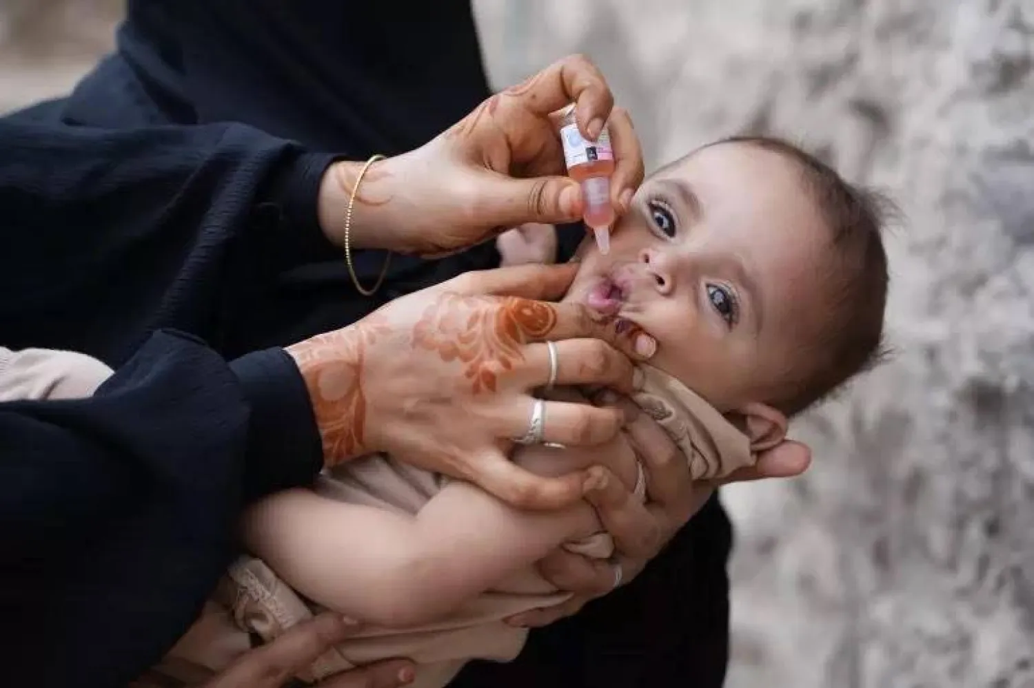 بعد 18 عاماً عاد شلل الأطفال للظهور في مناطق سيطرة الحوثيين (الأمم المتحدة)

