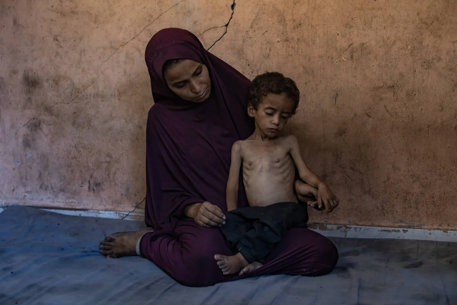 طفل فلسطيني عمره عامان يعاني من سوء التغذية الحاد نتيجة حصار قطاع غزة (إ.ب.أ)
