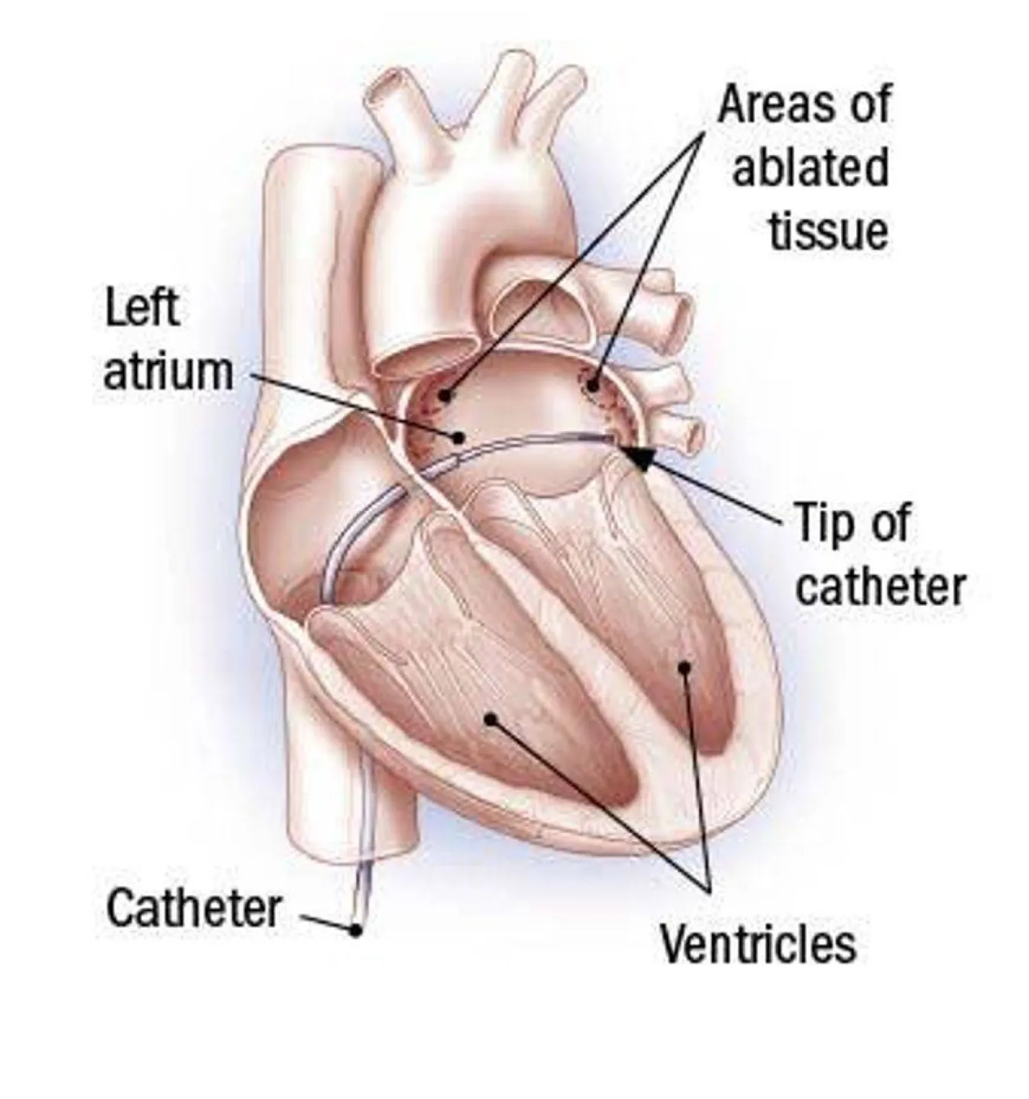 رسم توضيحي للاستئصال بالقسطرة - من الأعلى: مناطق الأنسجة المُستأصلة - الأذين الأيسر - طرف القسطرة - البطينان - القسطرة
