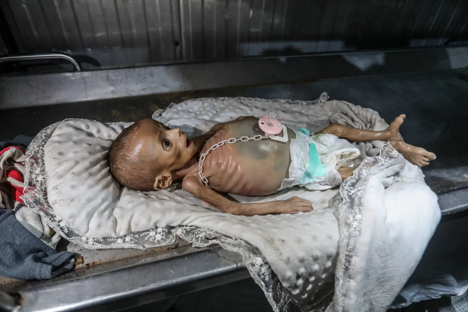 وُضعت الطفلة الفلسطينية زينب أبو حليب البالغة من العمر ستة أشهر على سرير بعد وفاتها في مستشفى ناصر بخان يونس بسبب سوء التغذية الحادّ (د.ب.أ)