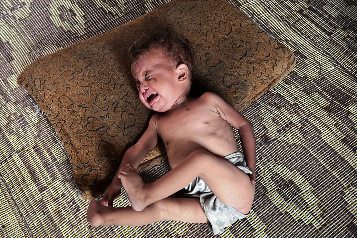 طفل فلسطيني يعاني من سوء تغذية حاد في مخيم النصيرات للاجئين وسط قطاع غزة (د.ب.أ)