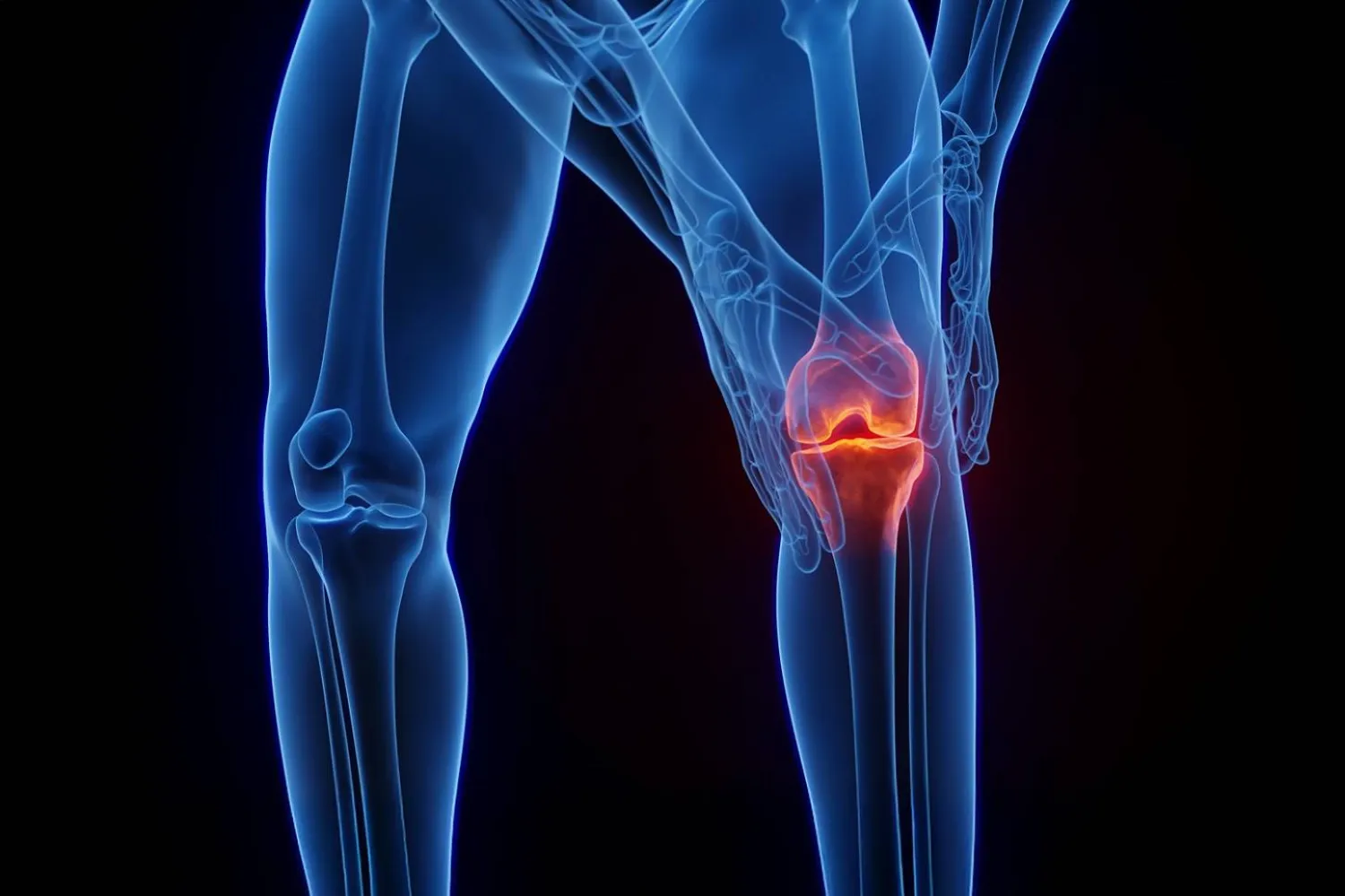 الألم المزمن الناتج عن هشاشة مفاصل الركبة يعد حالة طبية شائعة (جامعة نيويورك)
