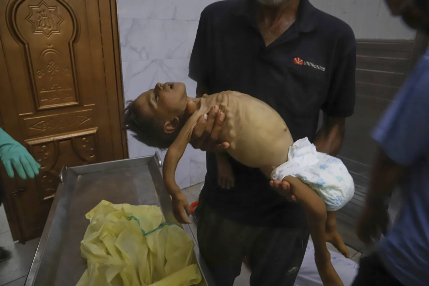 الطفل جمال النجار الذي توفي بسبب سوء تغذية شديد في مستشفى «ناصر» بخان يونس (أ.ب)