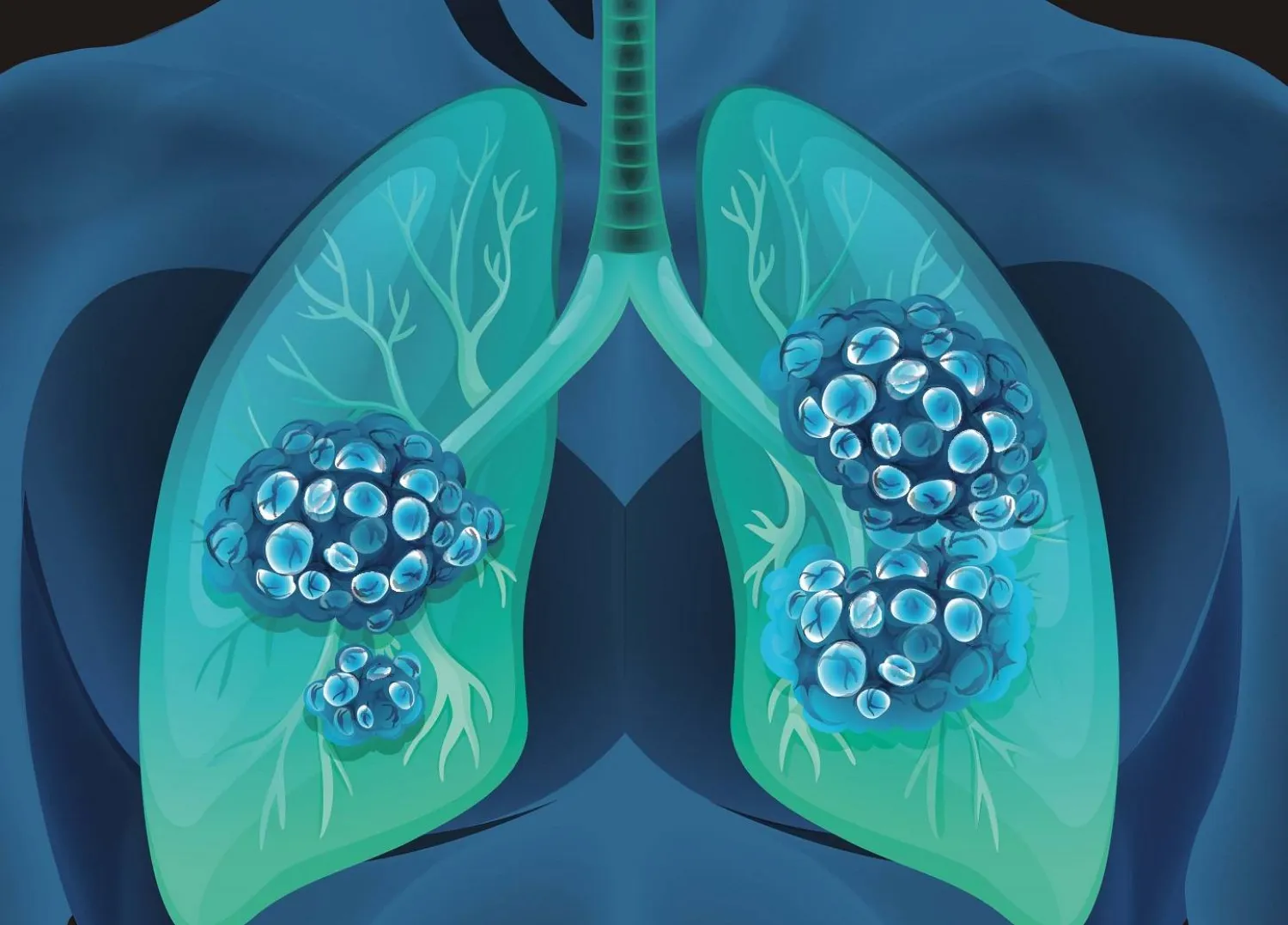 سرطان الرئة الأكثر فتكاً (جامعة فاندربيلت)