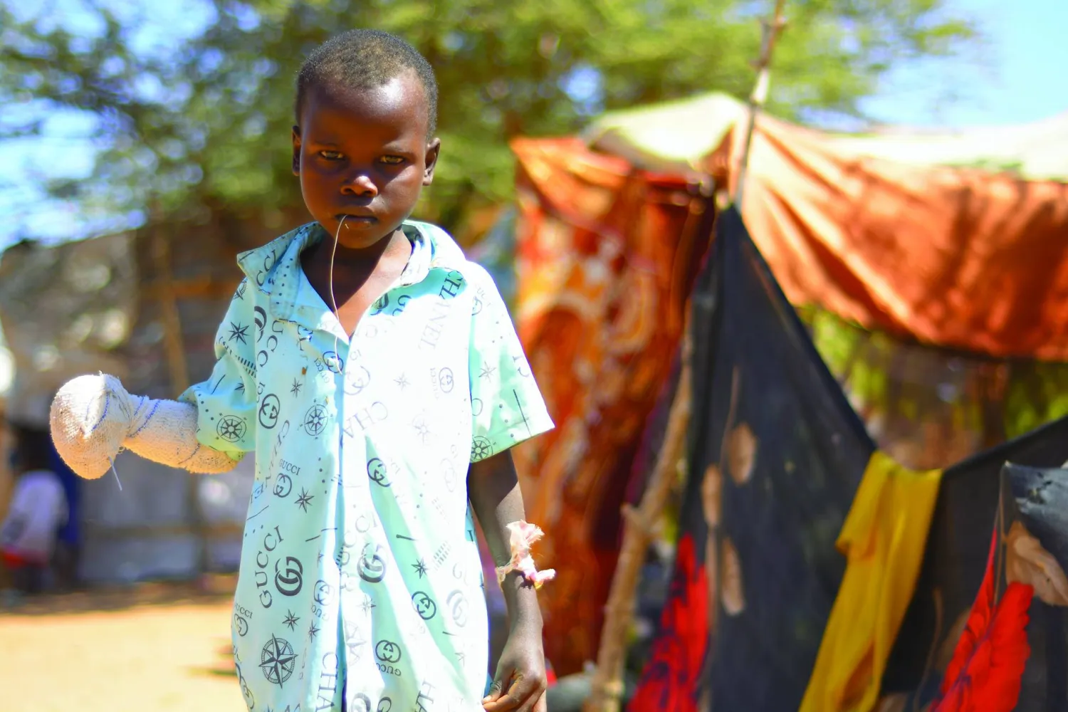 صورة وزعها «برنامج الغذاء العالمي» لطفل سوداني مصاب بيده في مخيم زمزم للنازحين في الفاشر نوفمبر 2024 (أ.ب)