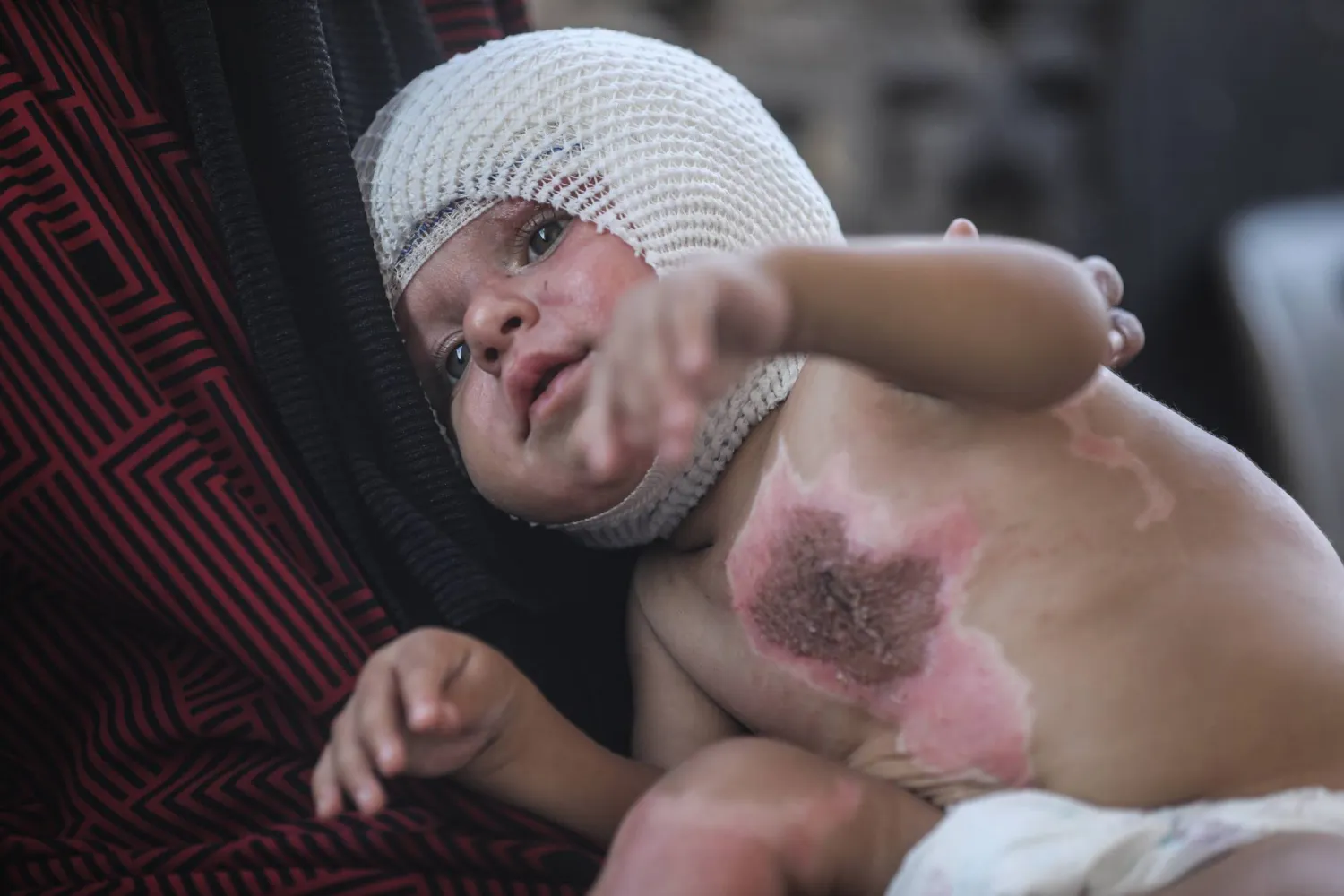 طفل فلسطيني مصاب بحروق شديدة جراء قصف إسرائيلي استهدف مدرسة تؤوي نازحين في غزة (أرشيفية - د.ب.أ)