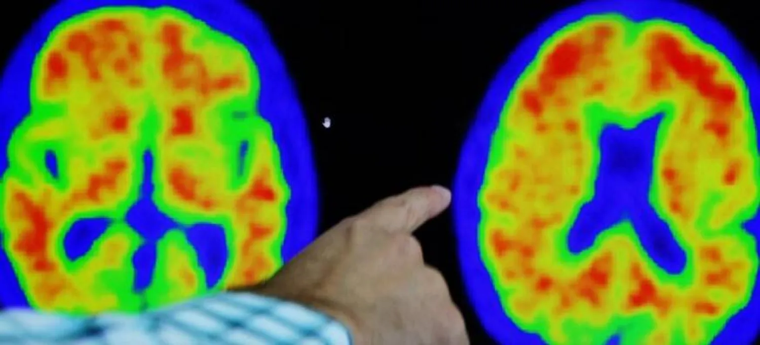 يوجد نحو من 20 إلى 25 في المائة من الكولسترول بالجسم في الدماغ (أرشيفية - رويترز)