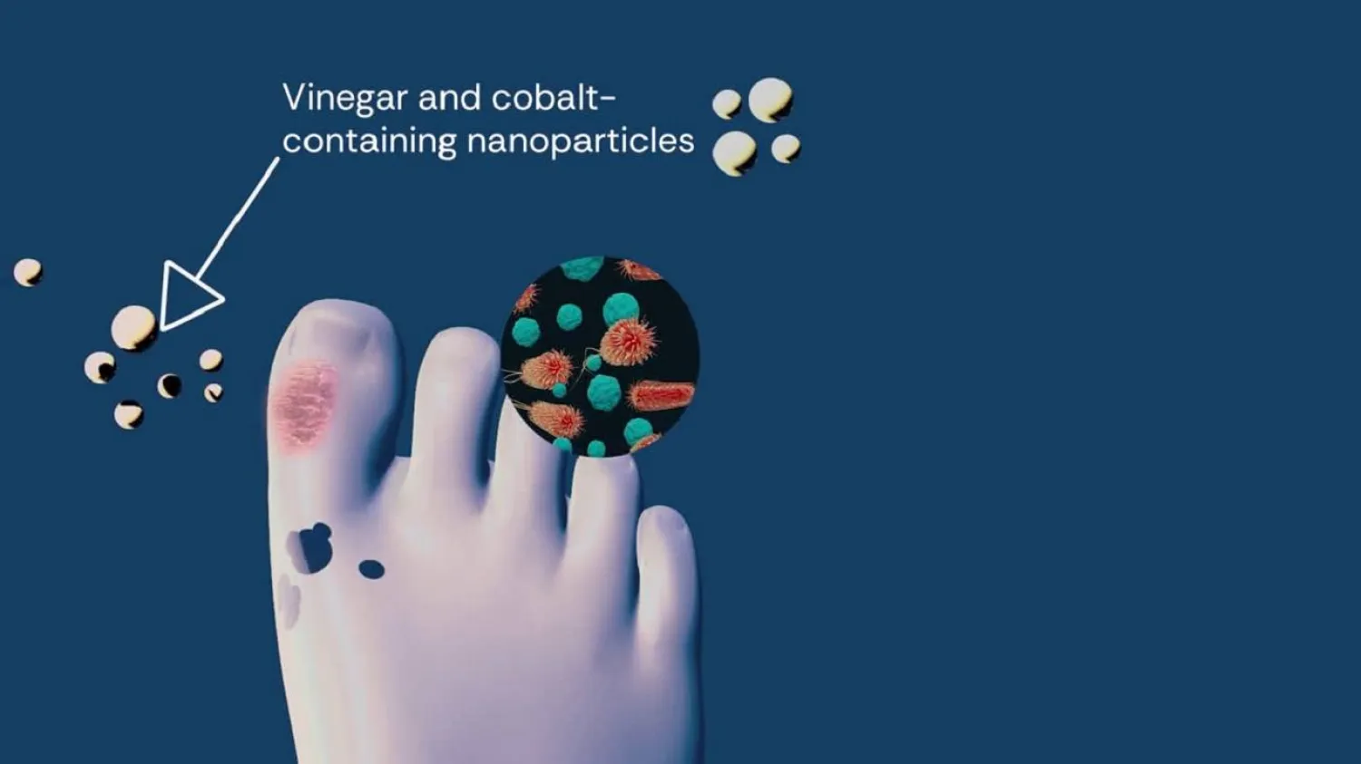 الباحثون أضافوا جزيئات نانوية مضادة للميكروبات رفعت من فاعلية الخل في علاج الجروح المزمنة (معهد كوينزلاند للأبحاث الطبية)