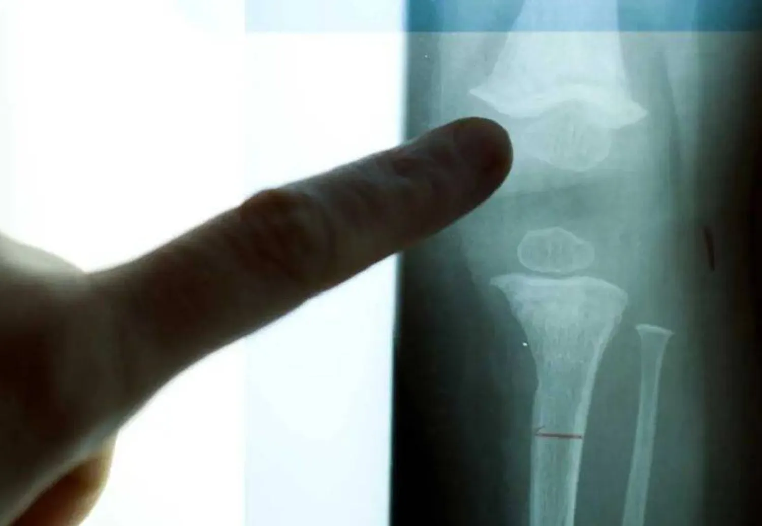 الزجاج يمكنه إصلاح تلف العظام ومساعدتها على النمو مجدداً (رويترز)