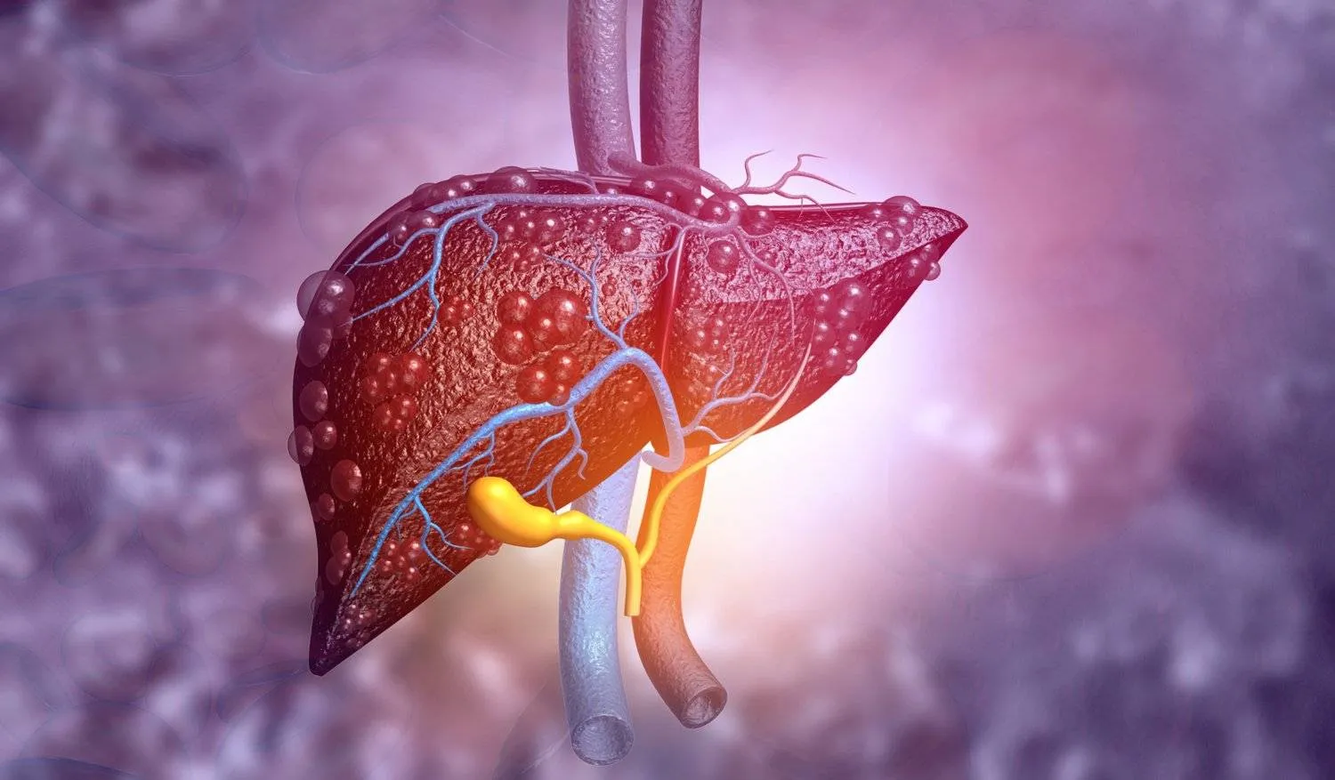 أمراض الكبد تؤدي لتلف تدريجي في الأنسجة وإضعاف قدرة الكبد على أداء وظائفه الأساسية (معهد كارولينسكا)